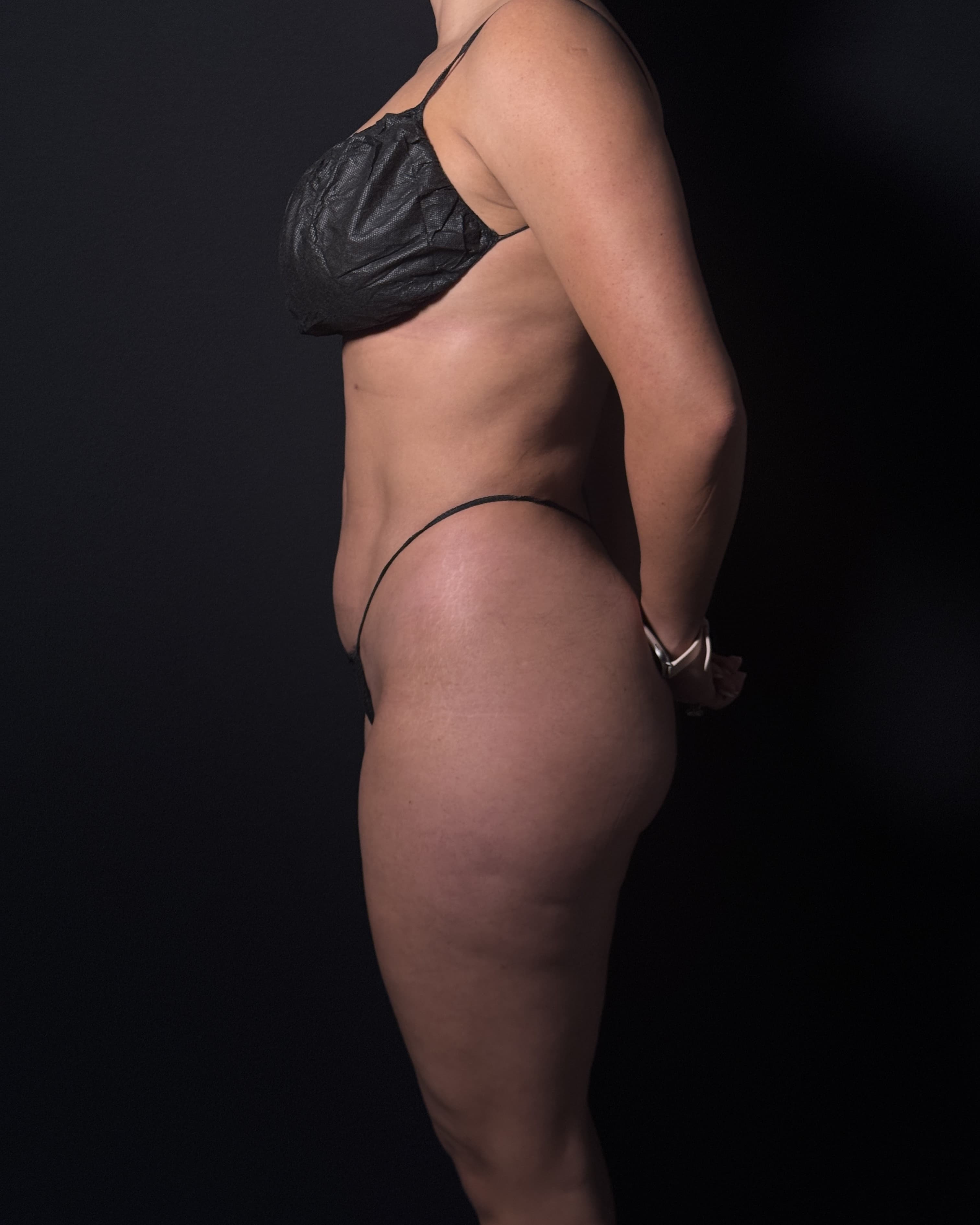High-Definition Liposuction 360 After - Patient 1282 - Left View
