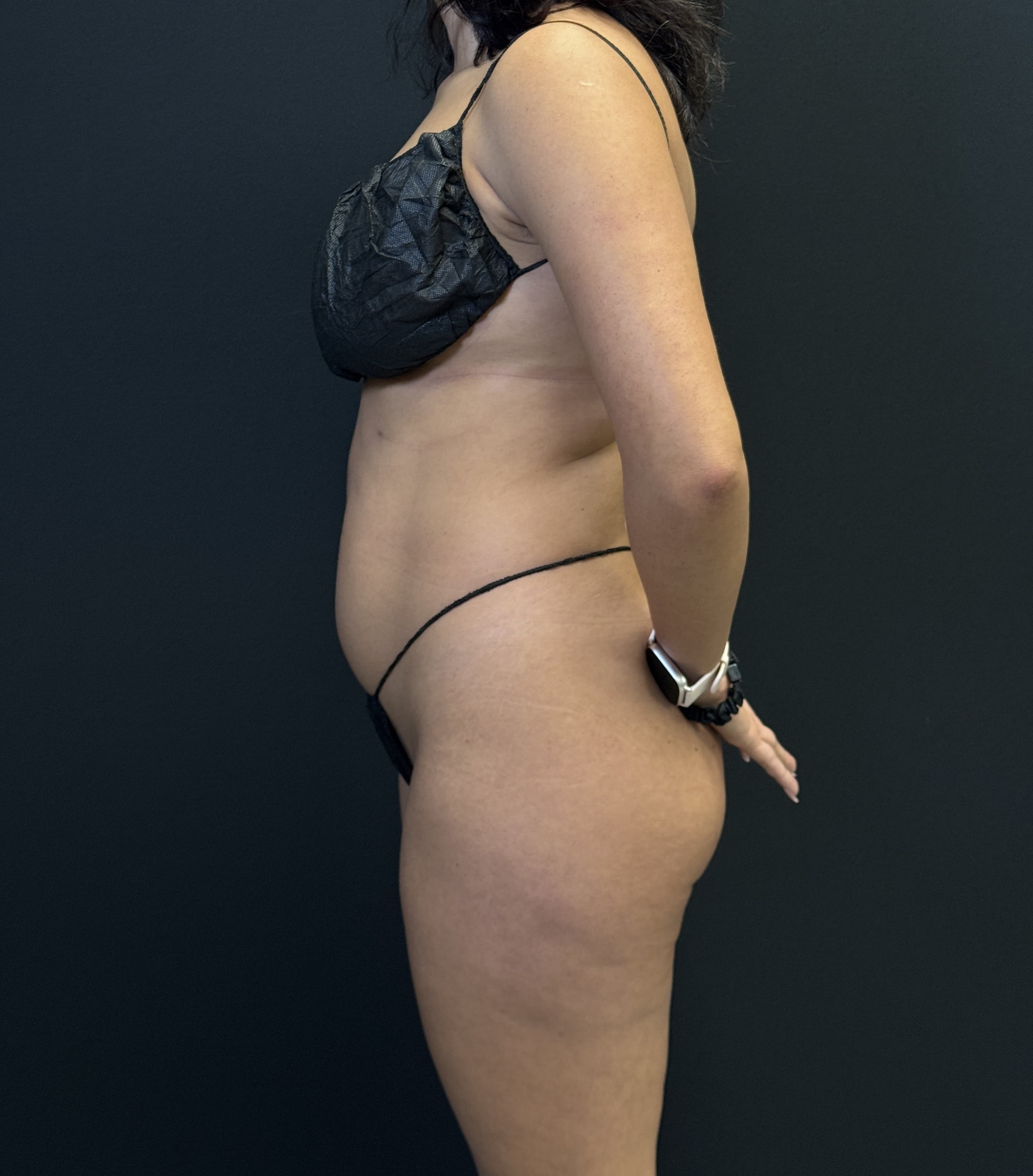 High-Definition Liposuction 360 Before - Patient 1282 - Left View