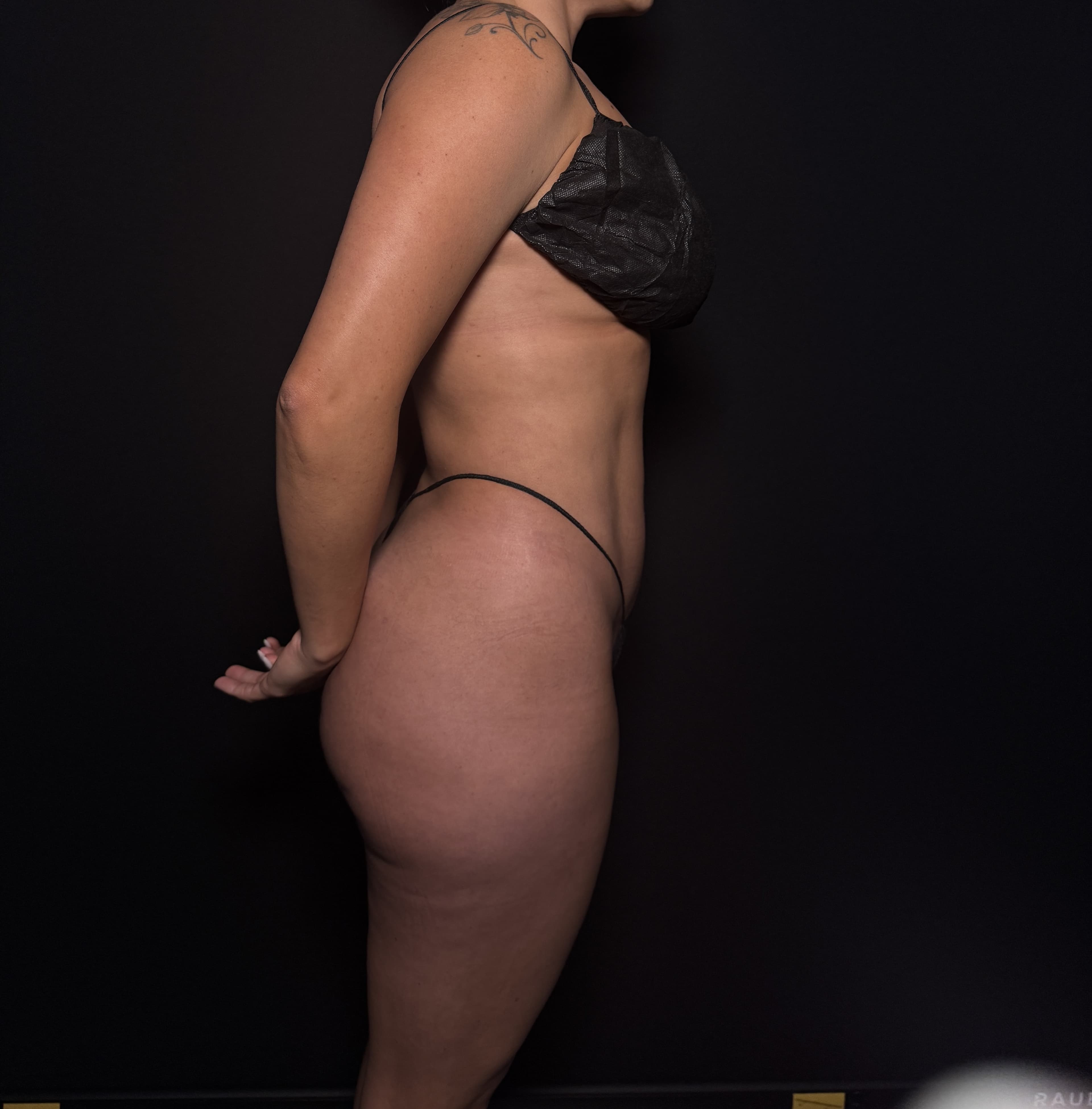 High-Definition Liposuction 360 After - Patient 1282 - Right View