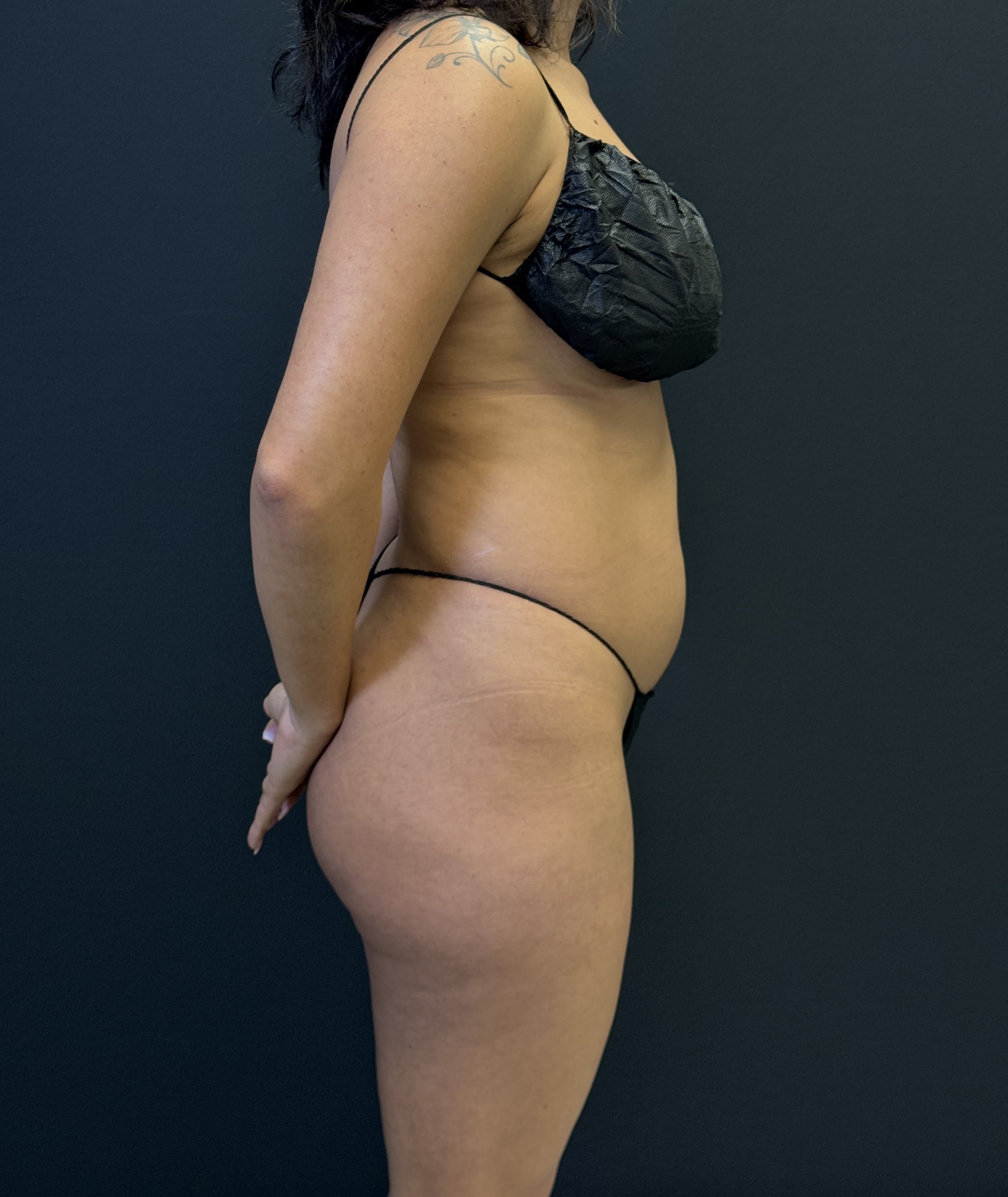 High-Definition Liposuction 360 Before - Patient 1282 - Right View