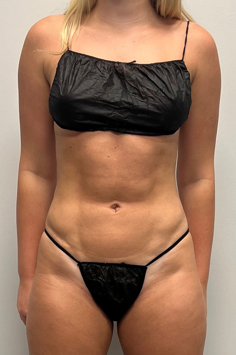 High-Definition Liposuction 360 After - Patient 417358 - Front View