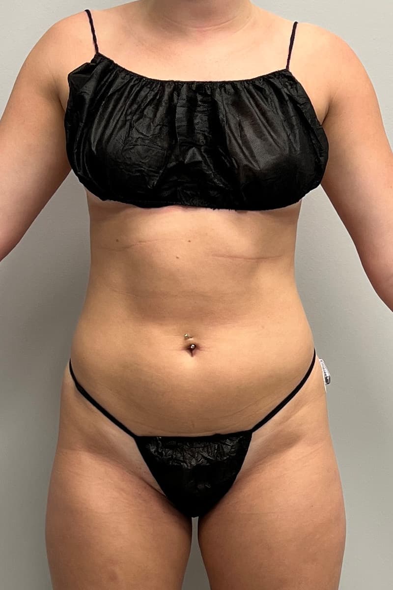 High-Definition Liposuction 360 Before - Patient 417358 - Front View