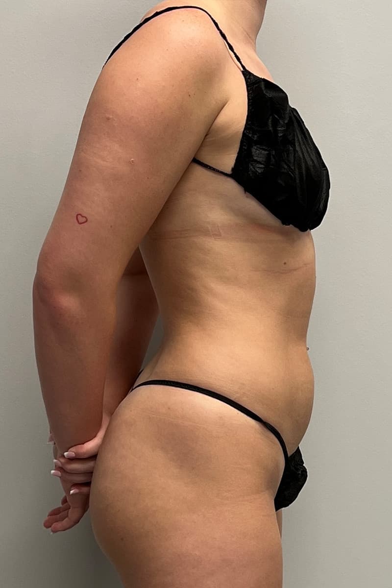 High-Definition Liposuction 360 Before - Patient 417358 - Right View