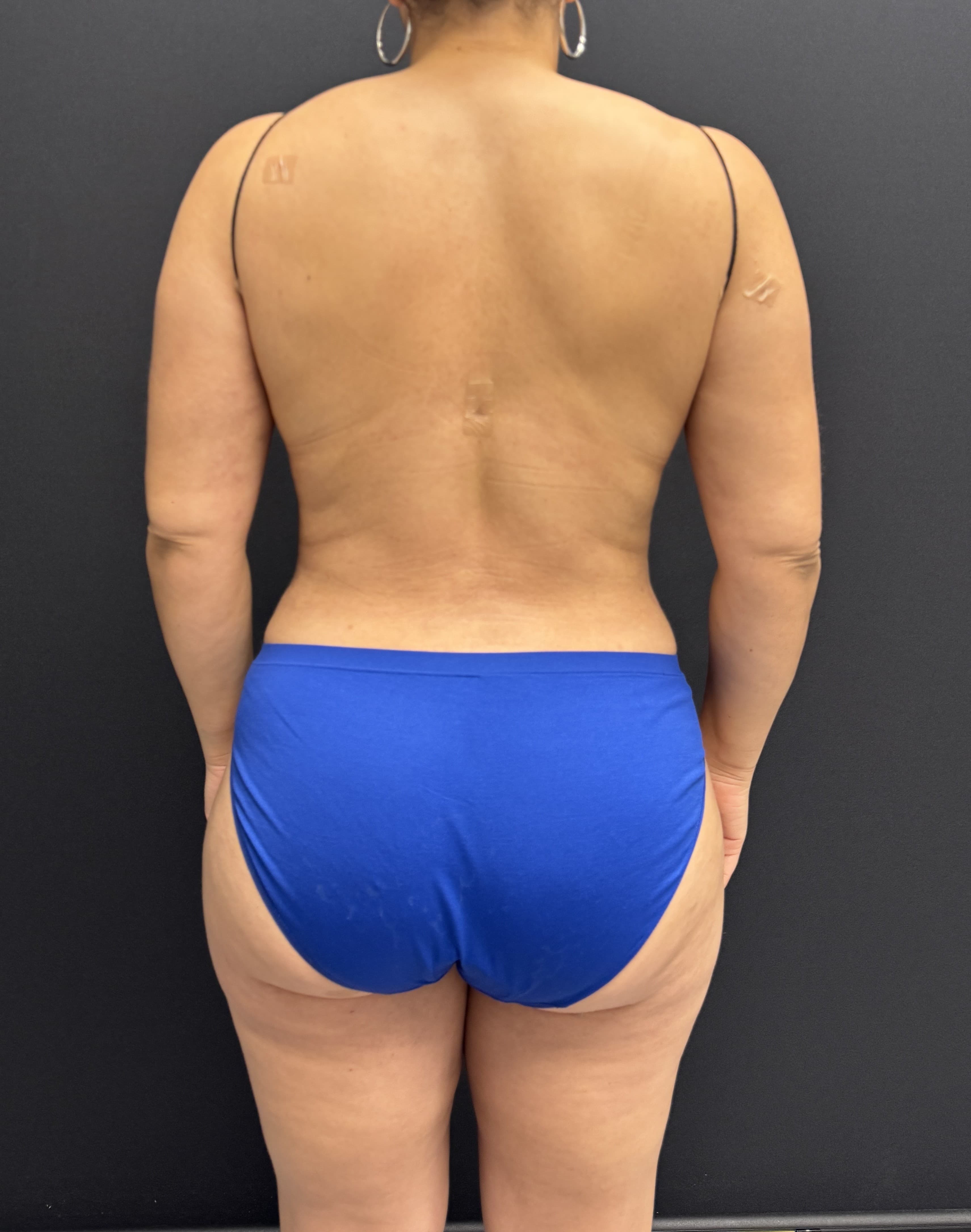 High-Definition Liposuction 360 After - Patient 4746 - Back View