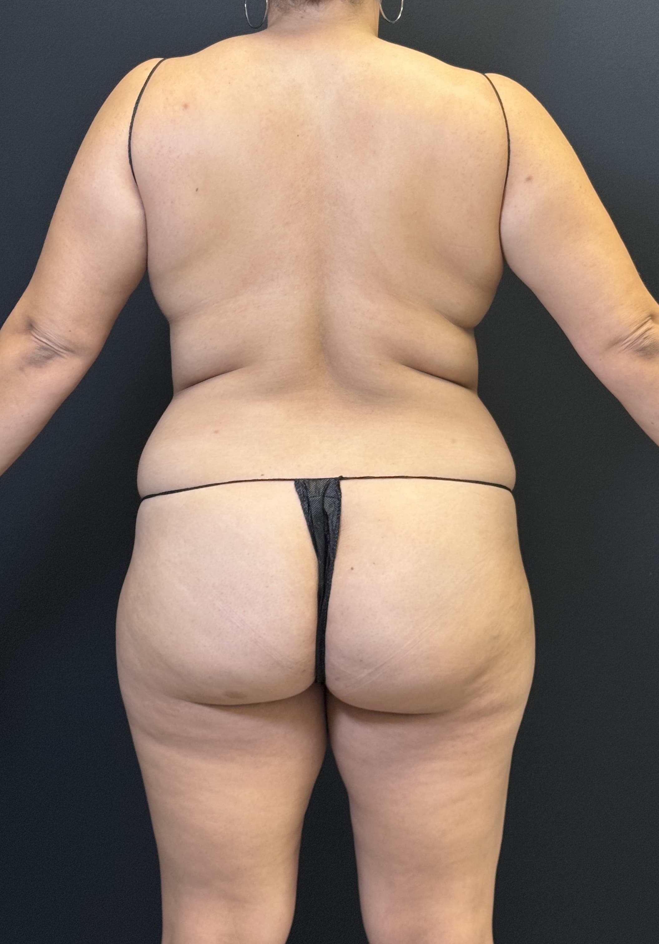 High-Definition Liposuction 360 Before - Patient 4746 - Back View