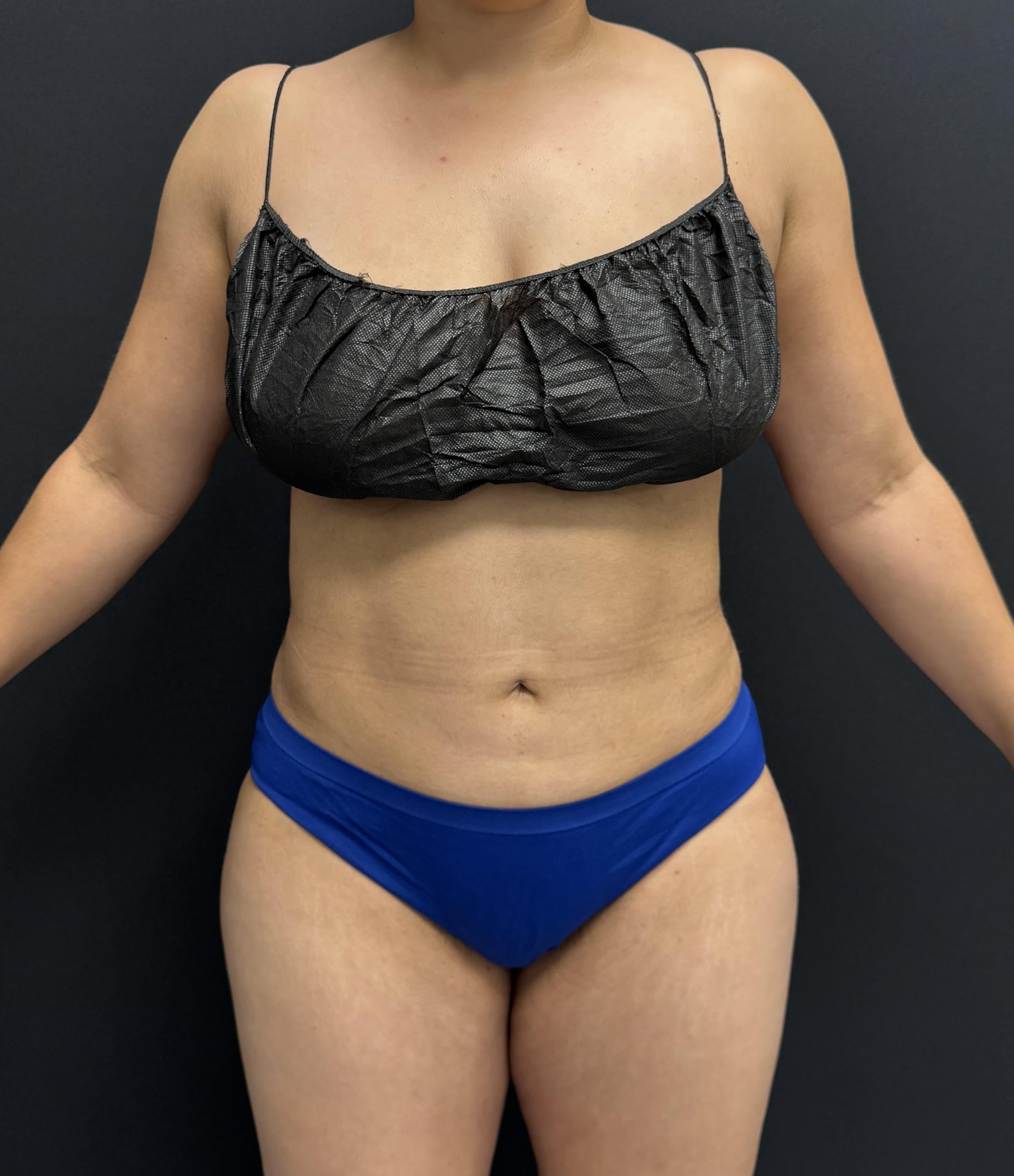 High-Definition Liposuction 360 After - Patient 4746 - Front View