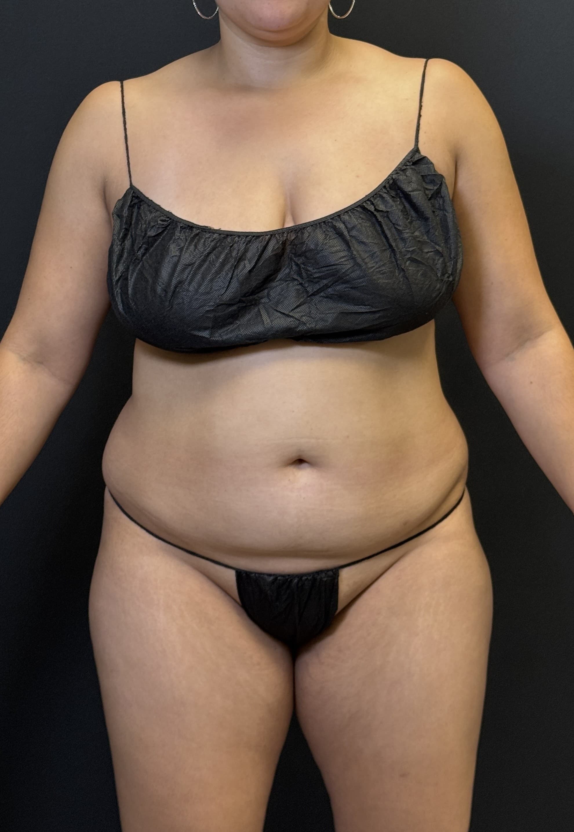 High-Definition Liposuction 360 Before - Patient 4746 - Front View