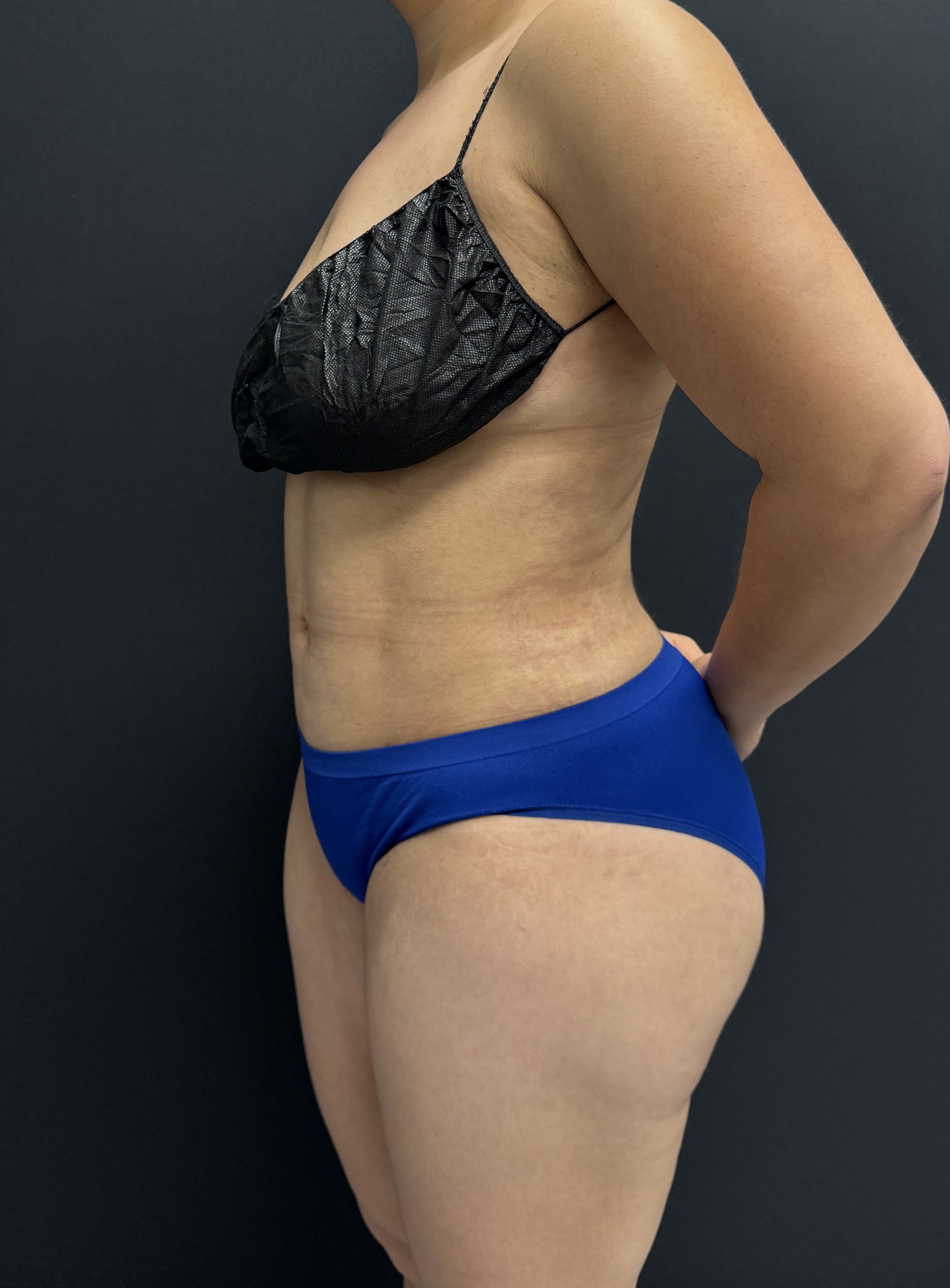 High-Definition Liposuction 360 After - Patient 4746 - Front Left View