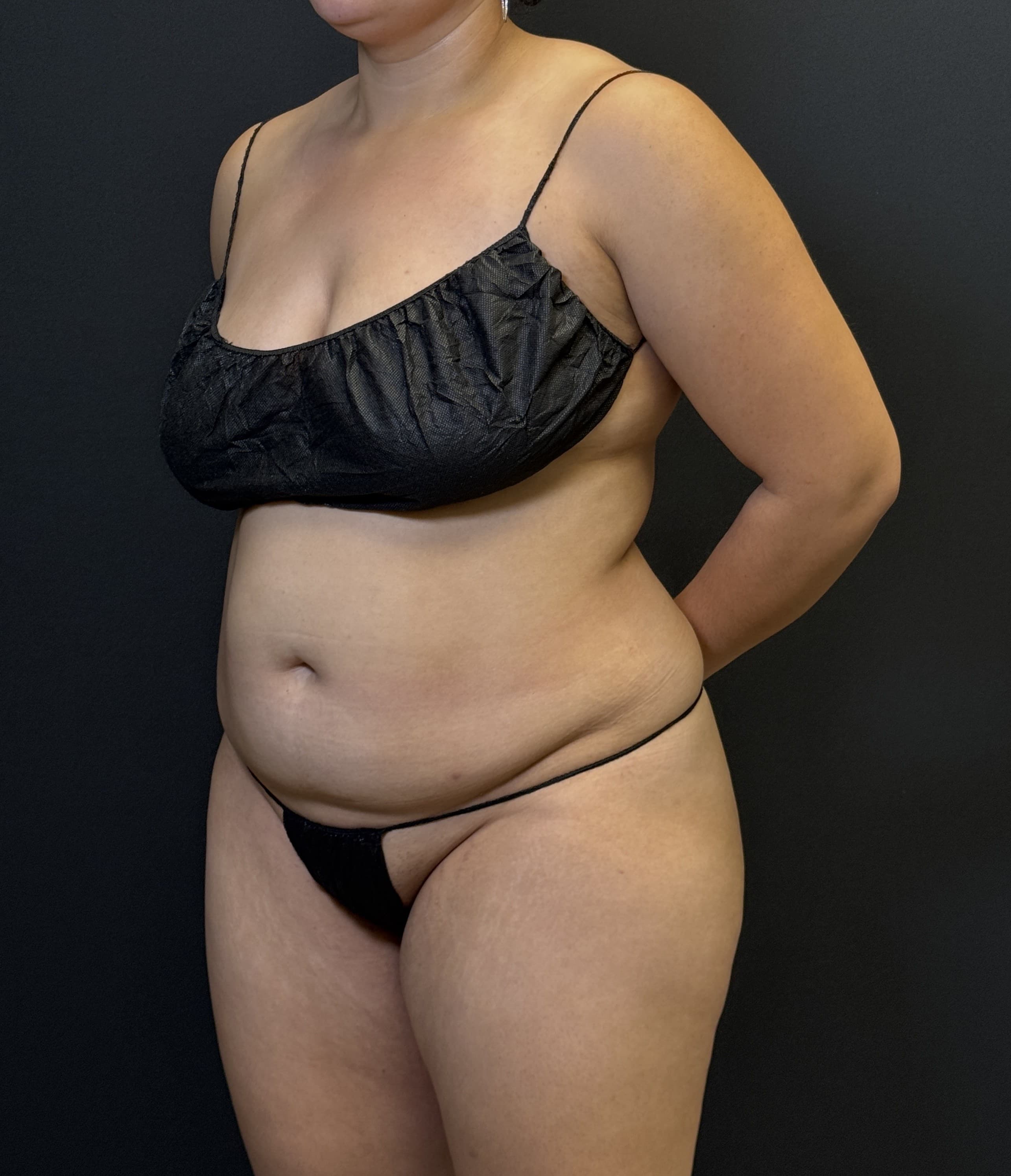 High-Definition Liposuction 360 Before - Patient 4746 - Front Left View