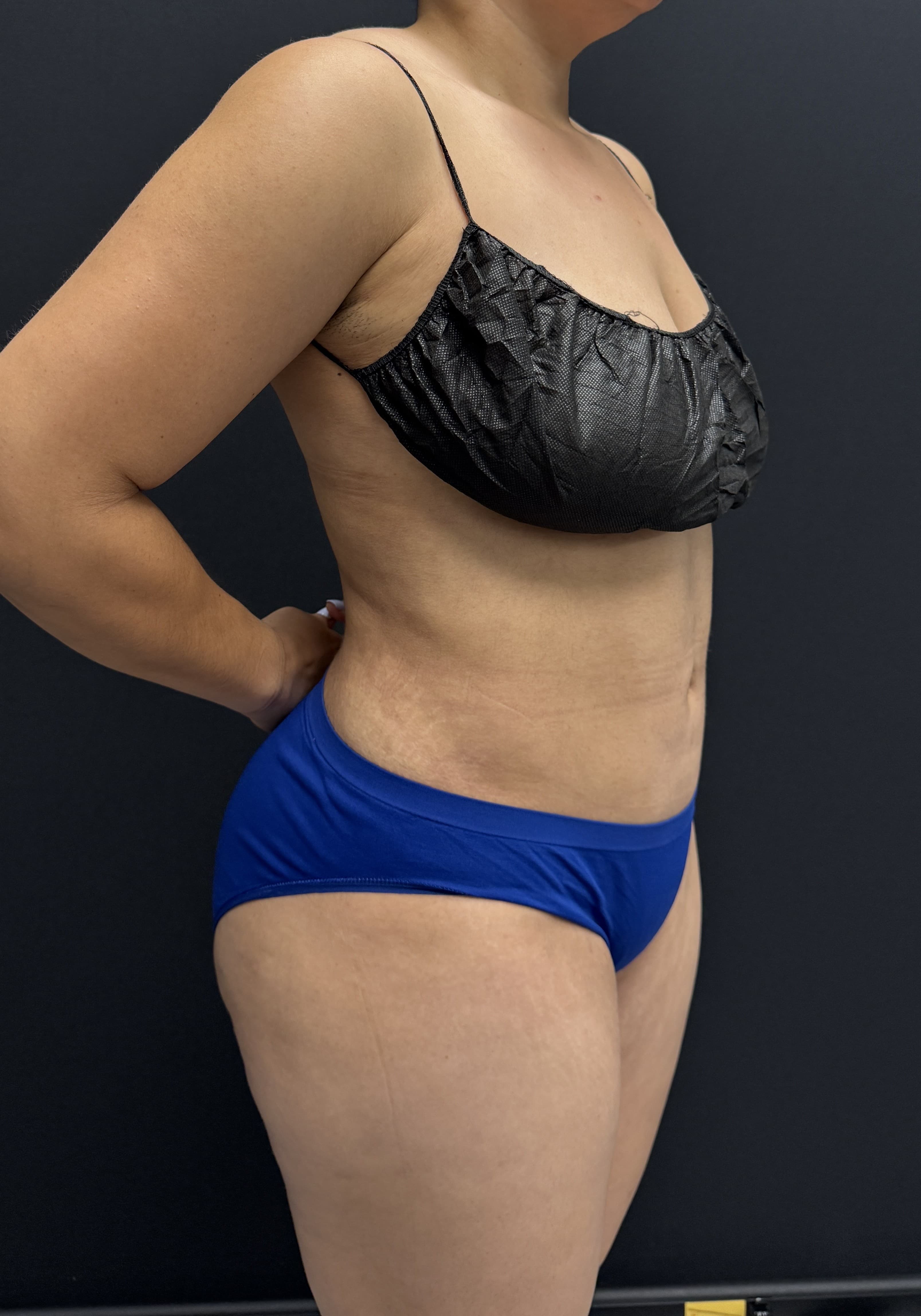 High-Definition Liposuction 360 After - Patient 4746 - Front Right View