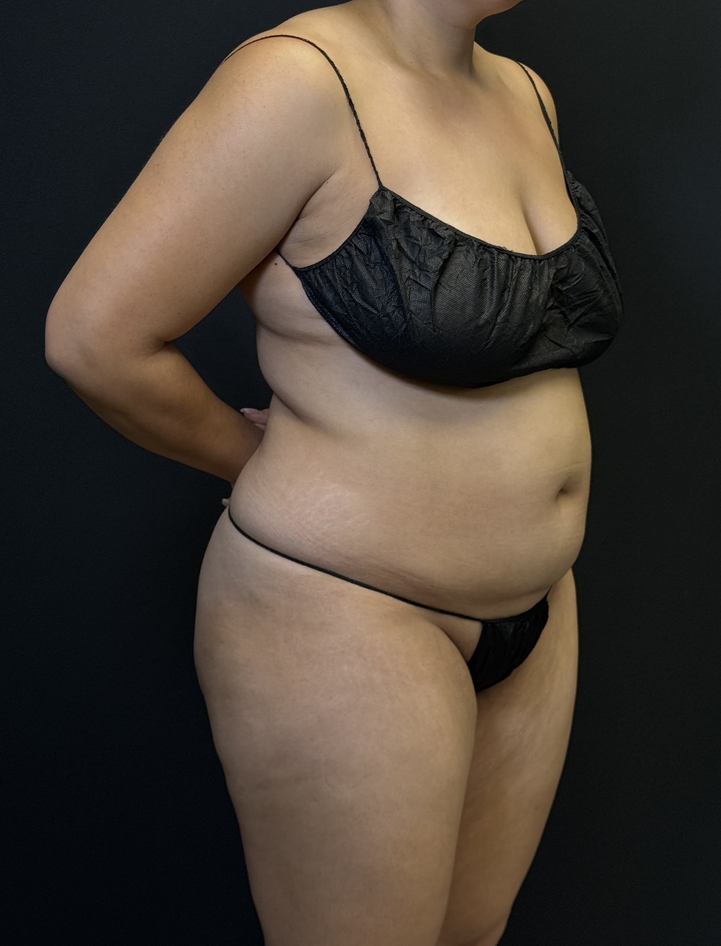 High-Definition Liposuction 360 Before - Patient 4746 - Front Right View