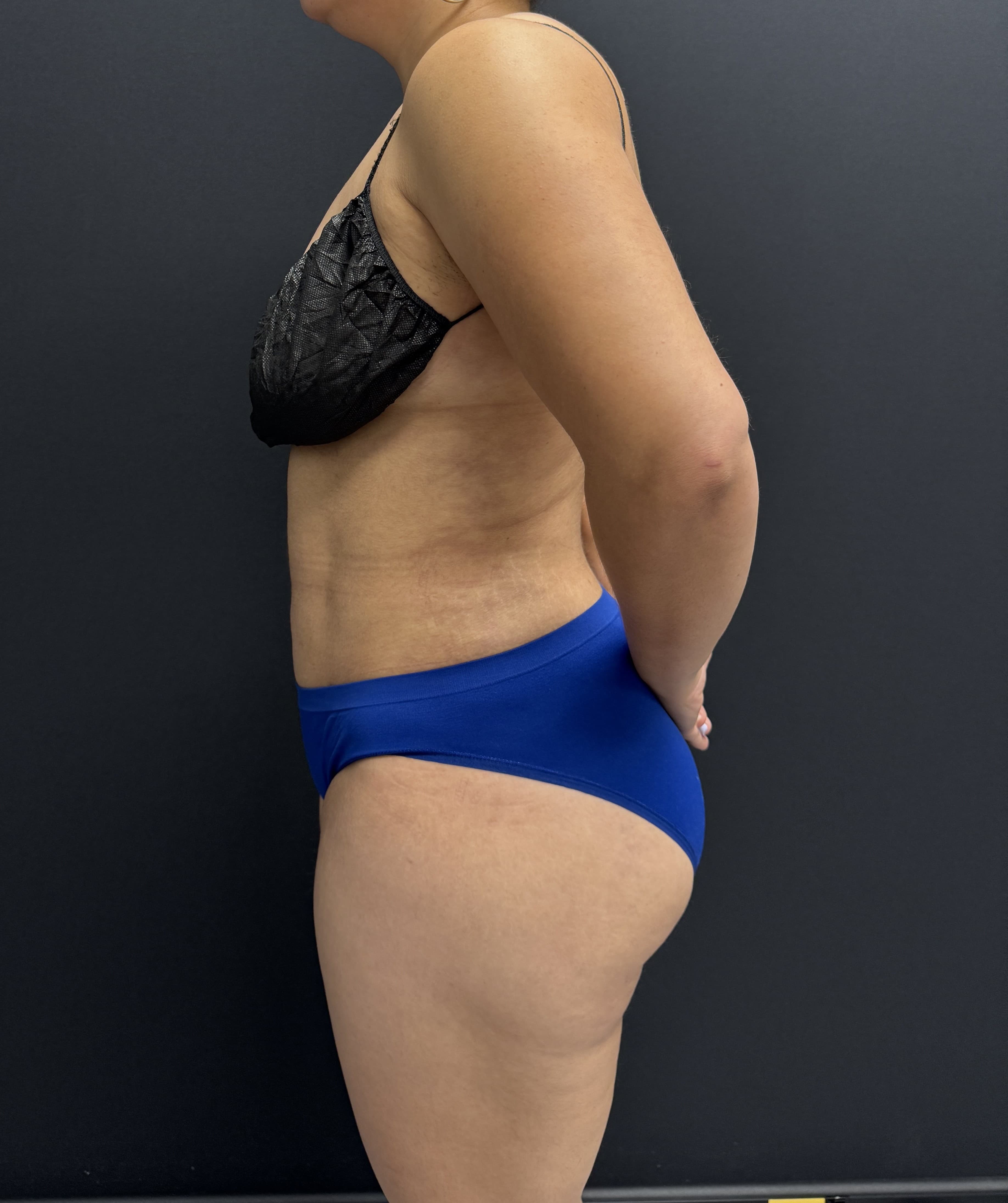 High-Definition Liposuction 360 After - Patient 4746 - Left View