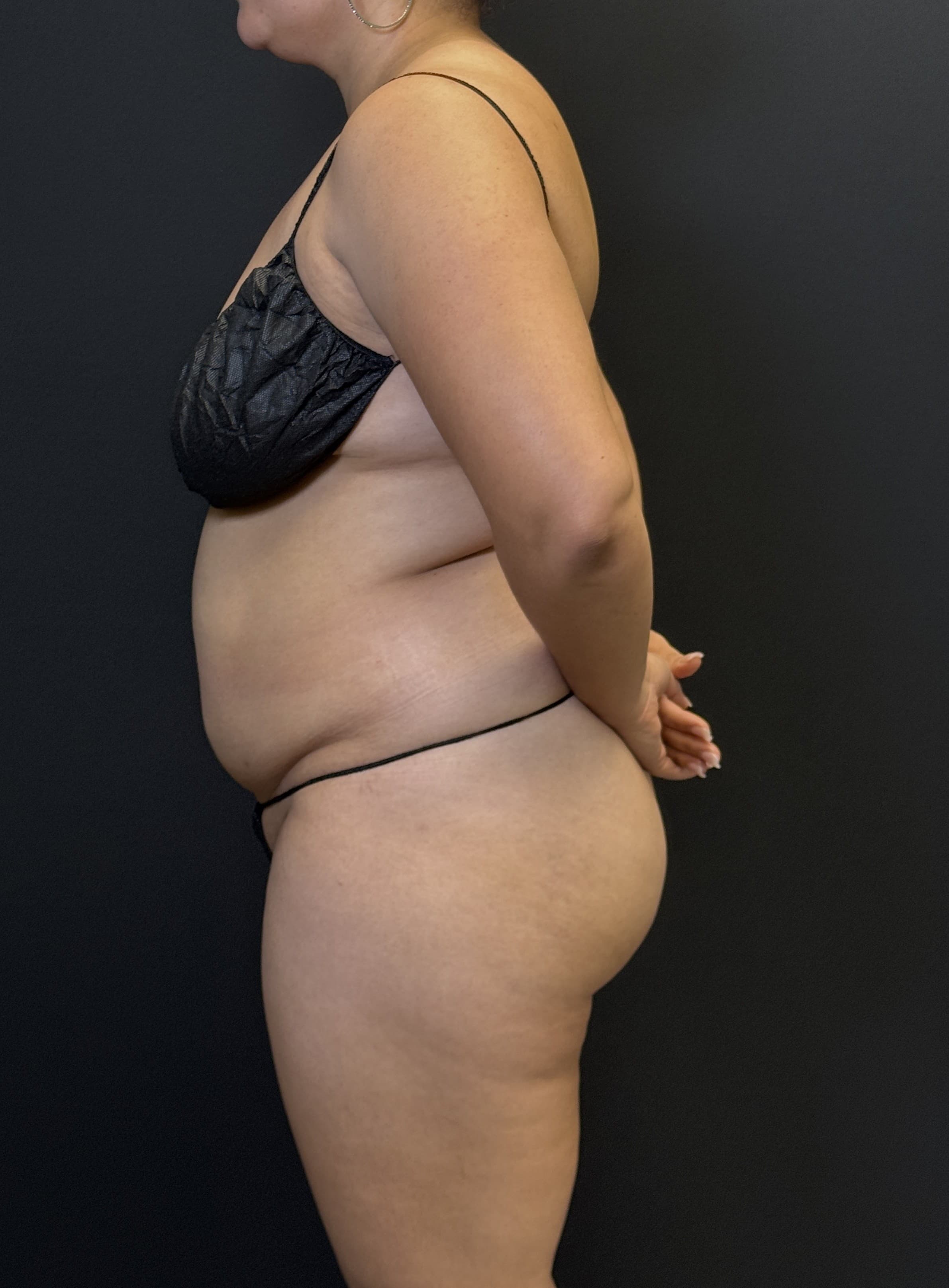 High-Definition Liposuction 360 Before - Patient 4746 - Left View