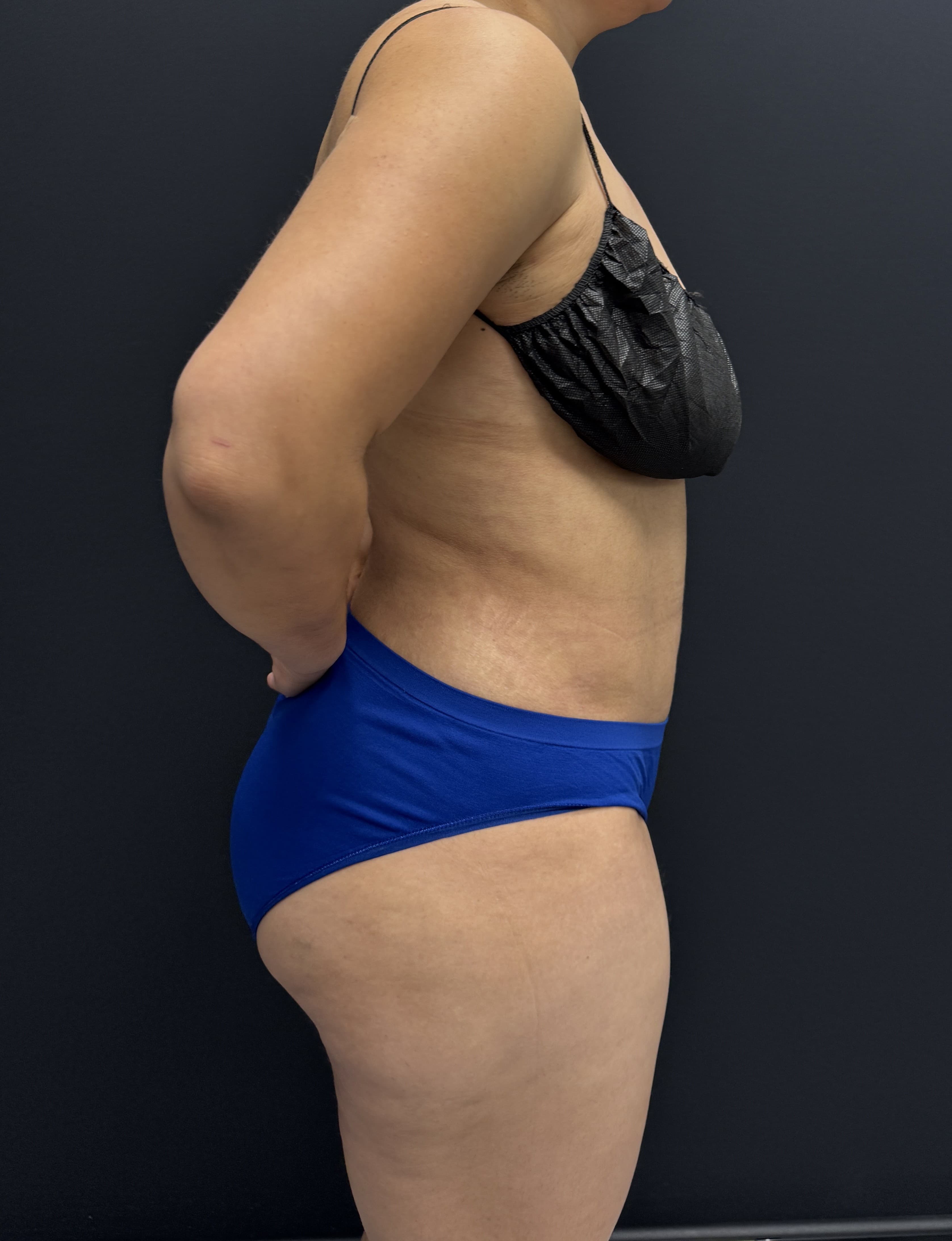 High-Definition Liposuction 360 After - Patient 4746 - Right View