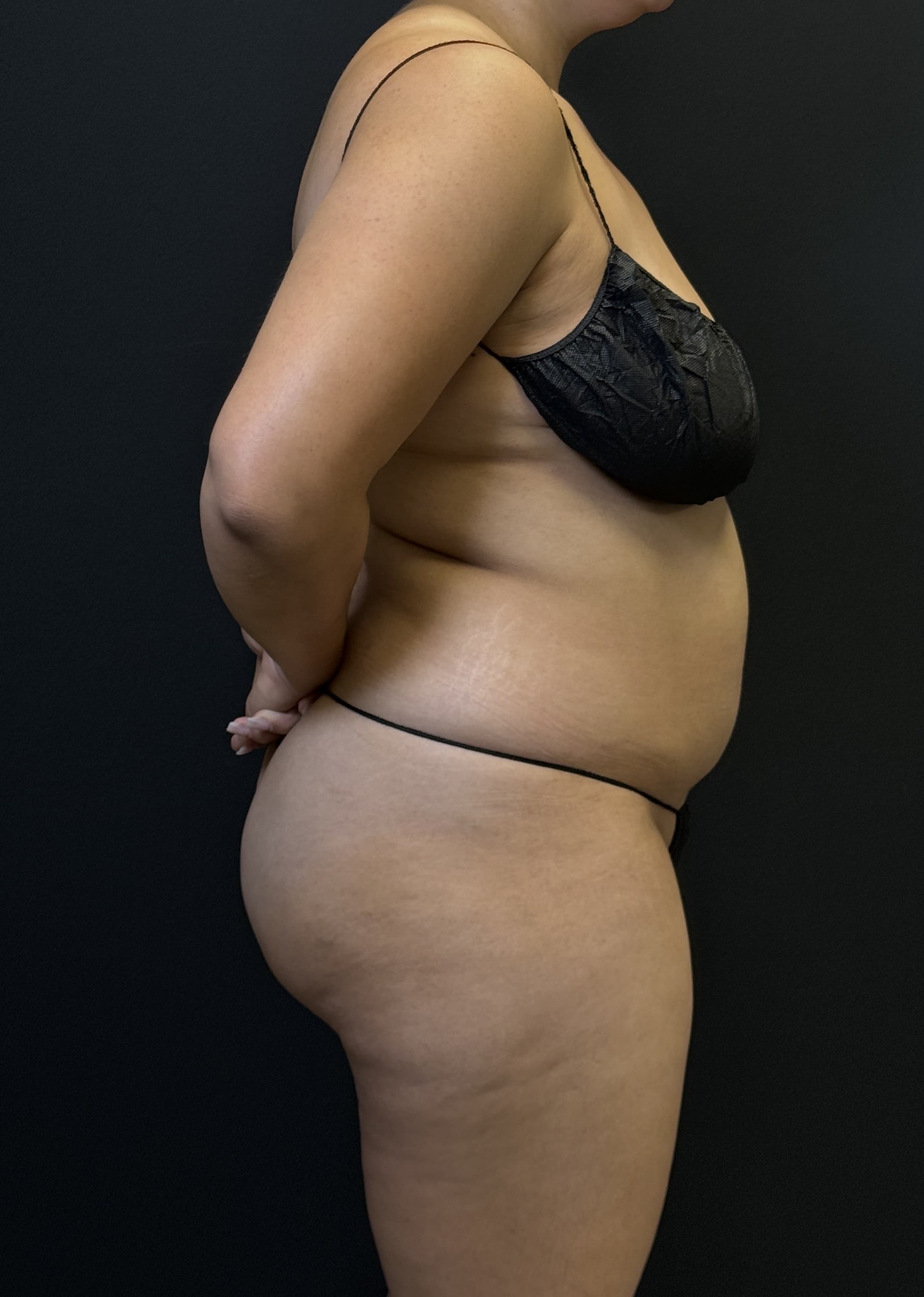 High-Definition Liposuction 360 Before - Patient 4746 - Right View