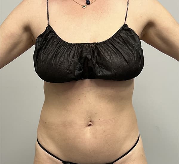 High-Definition Liposuction 360 Before - Patient 93894386 - Front View
