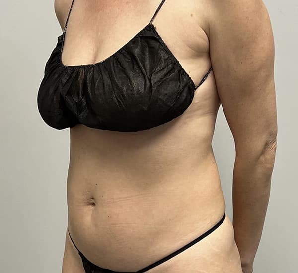 High-Definition Liposuction 360 Before - Patient 93894386 - Front Right View