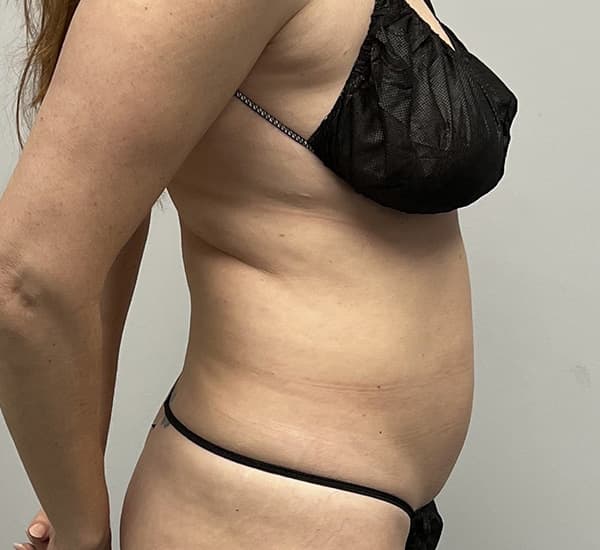 High-Definition Liposuction 360 Before - Patient 93894386 - Right View