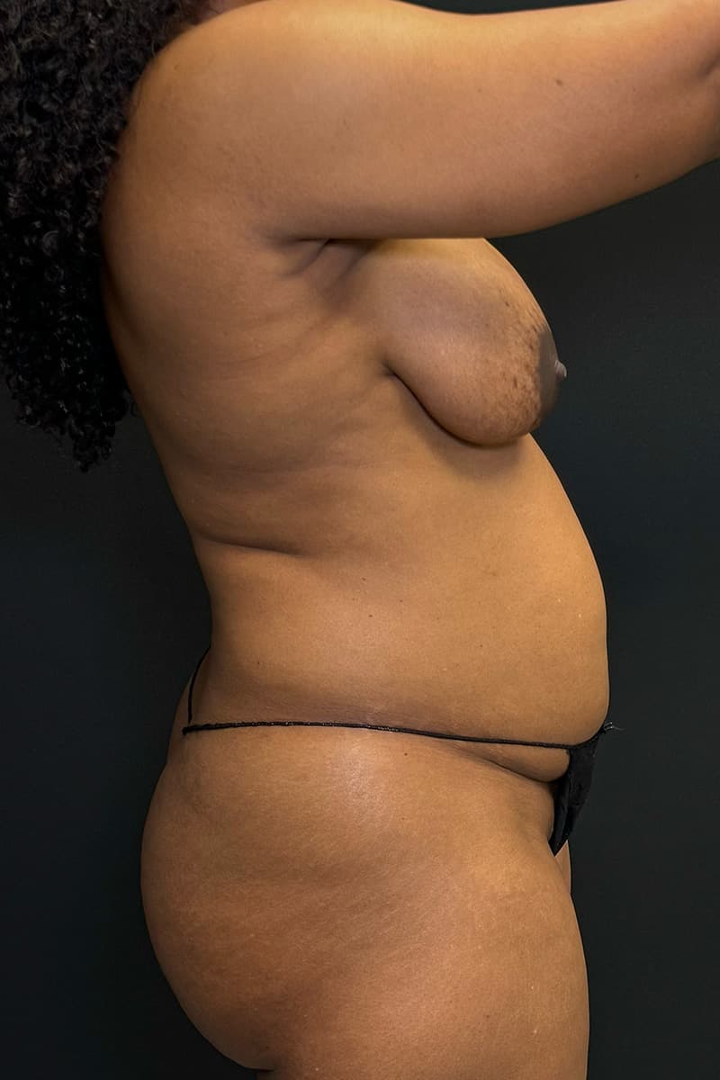 Tummy Tuck Before - Patient 156318 - Right 1 View