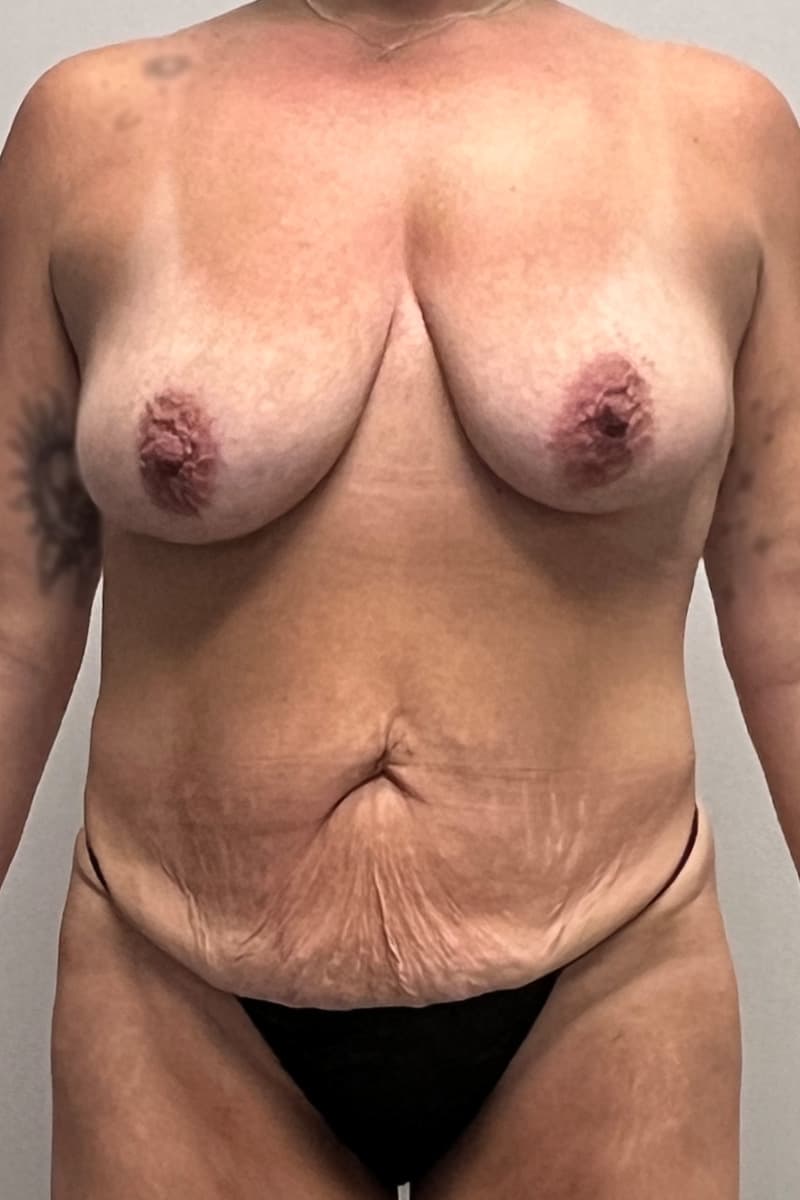 Tummy Tuck Before - Patient 181702 - Front View