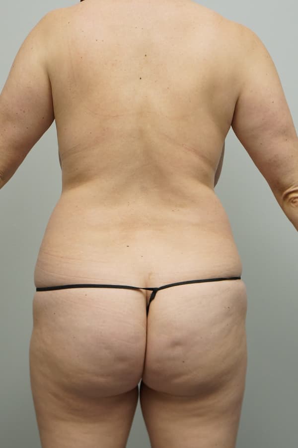 Mommy Makeover Before - Patient 234620 - Back View