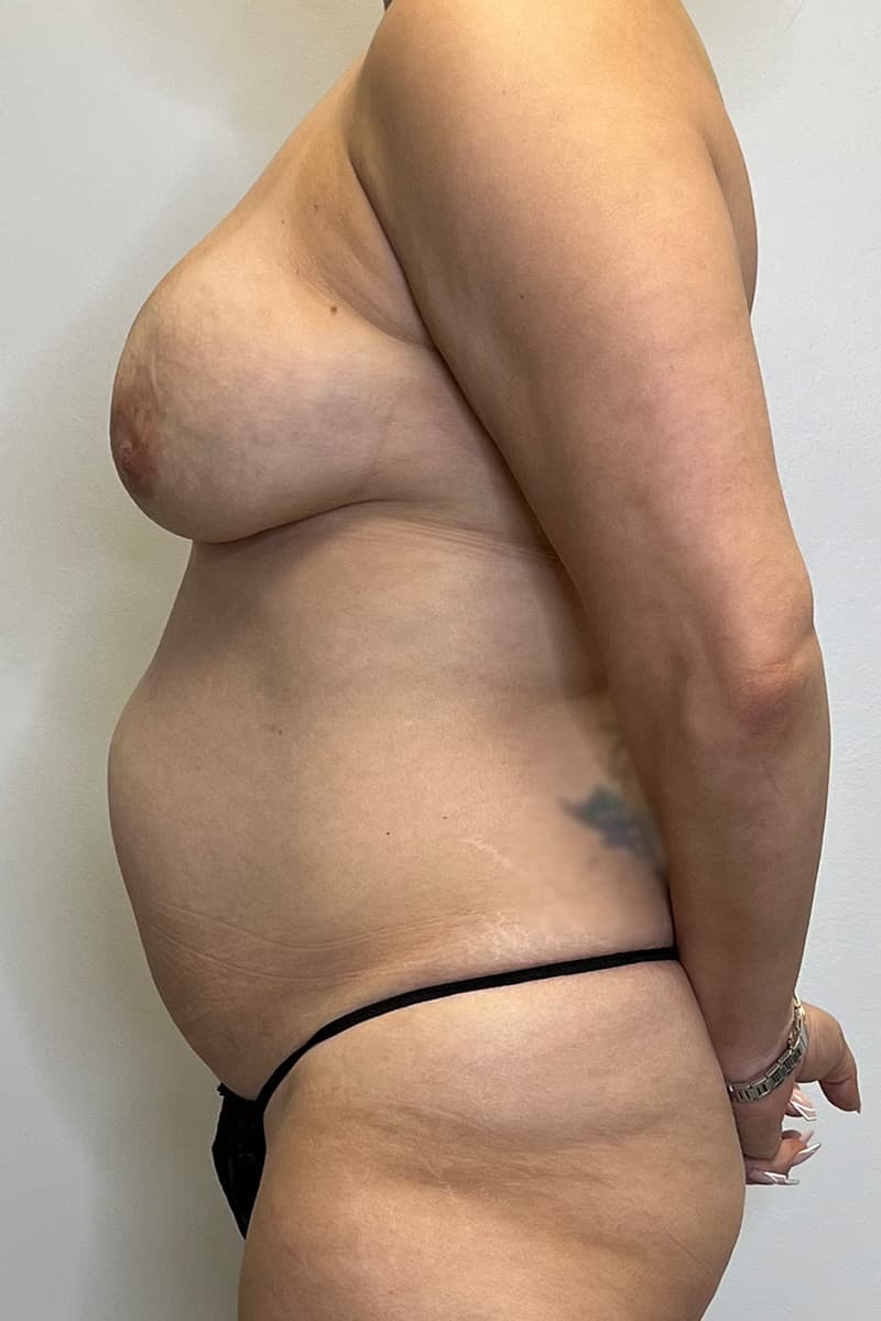 Tummy Tuck Before - Patient 491291 - Left View