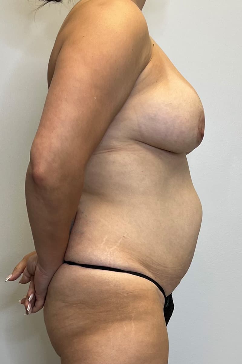 Tummy Tuck Before - Patient 491291 - Right View