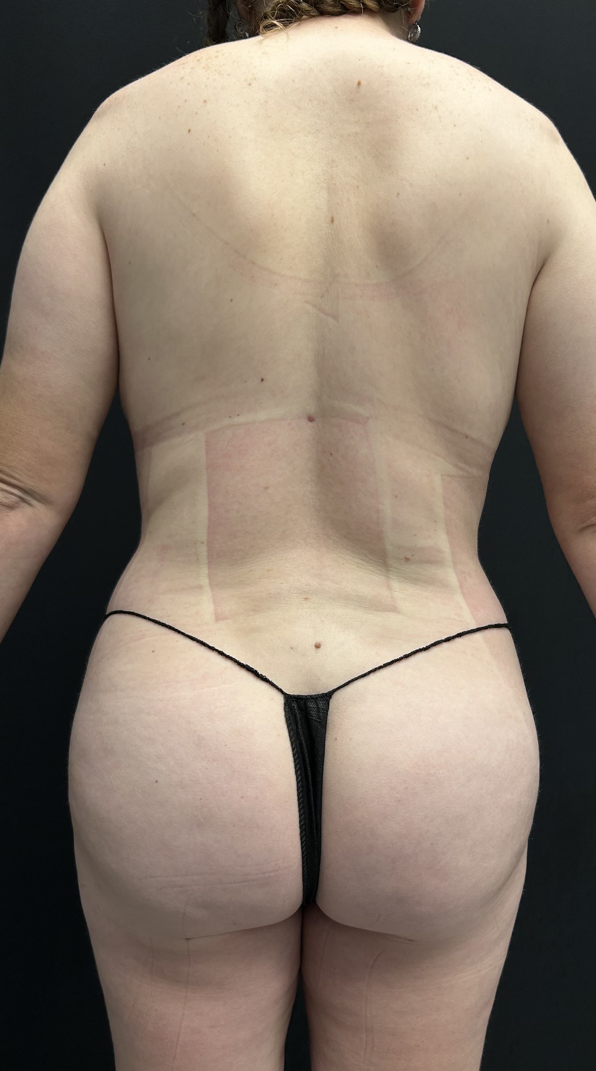 Mommy Makeover After - Patient 5289 - Back View
