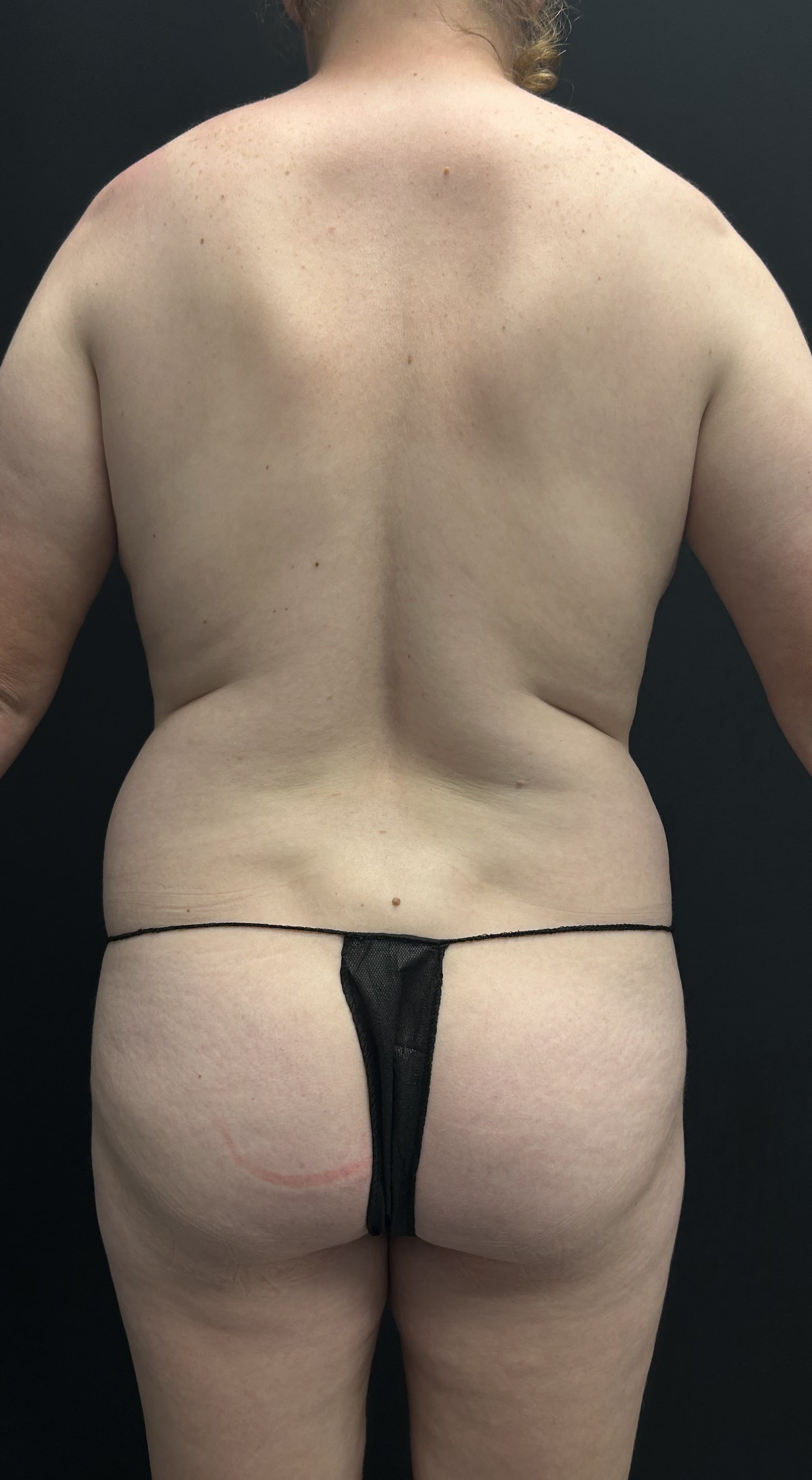 Mommy Makeover Before - Patient 5289 - Back View