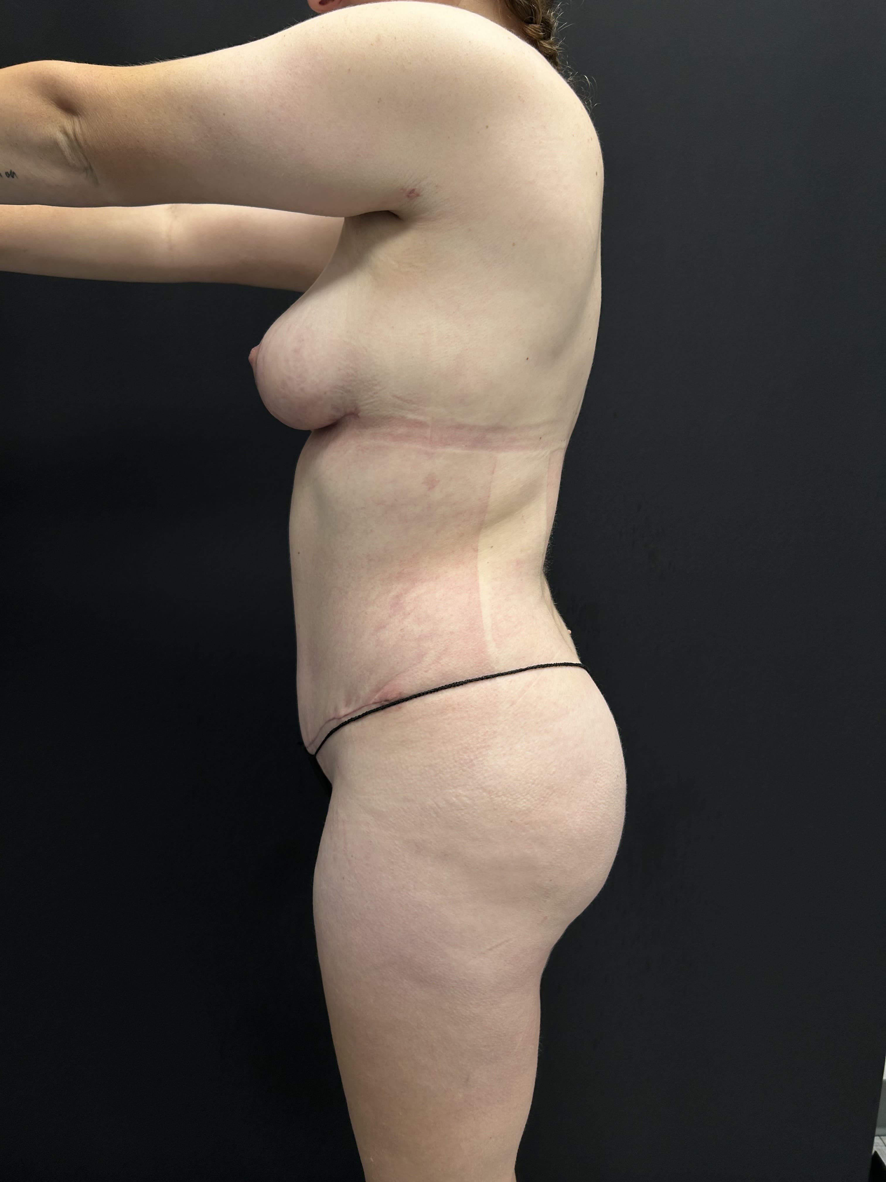 Mommy Makeover After - Patient 5289 - Left View