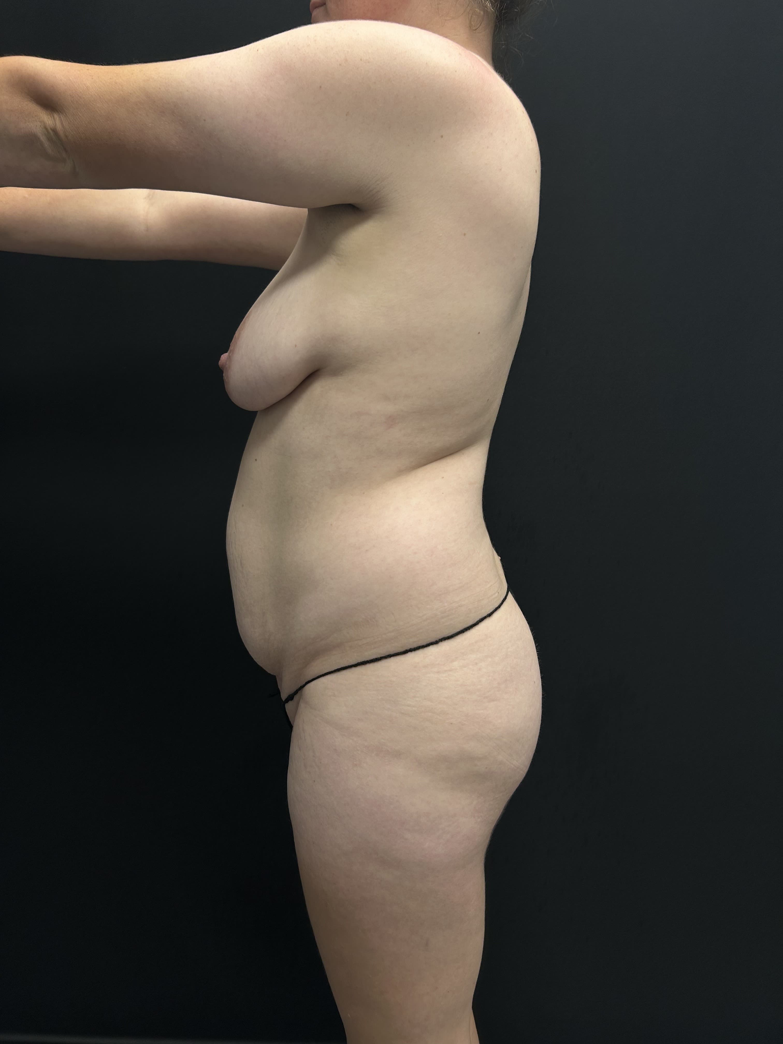 Mommy Makeover Before - Patient 5289 - Left View