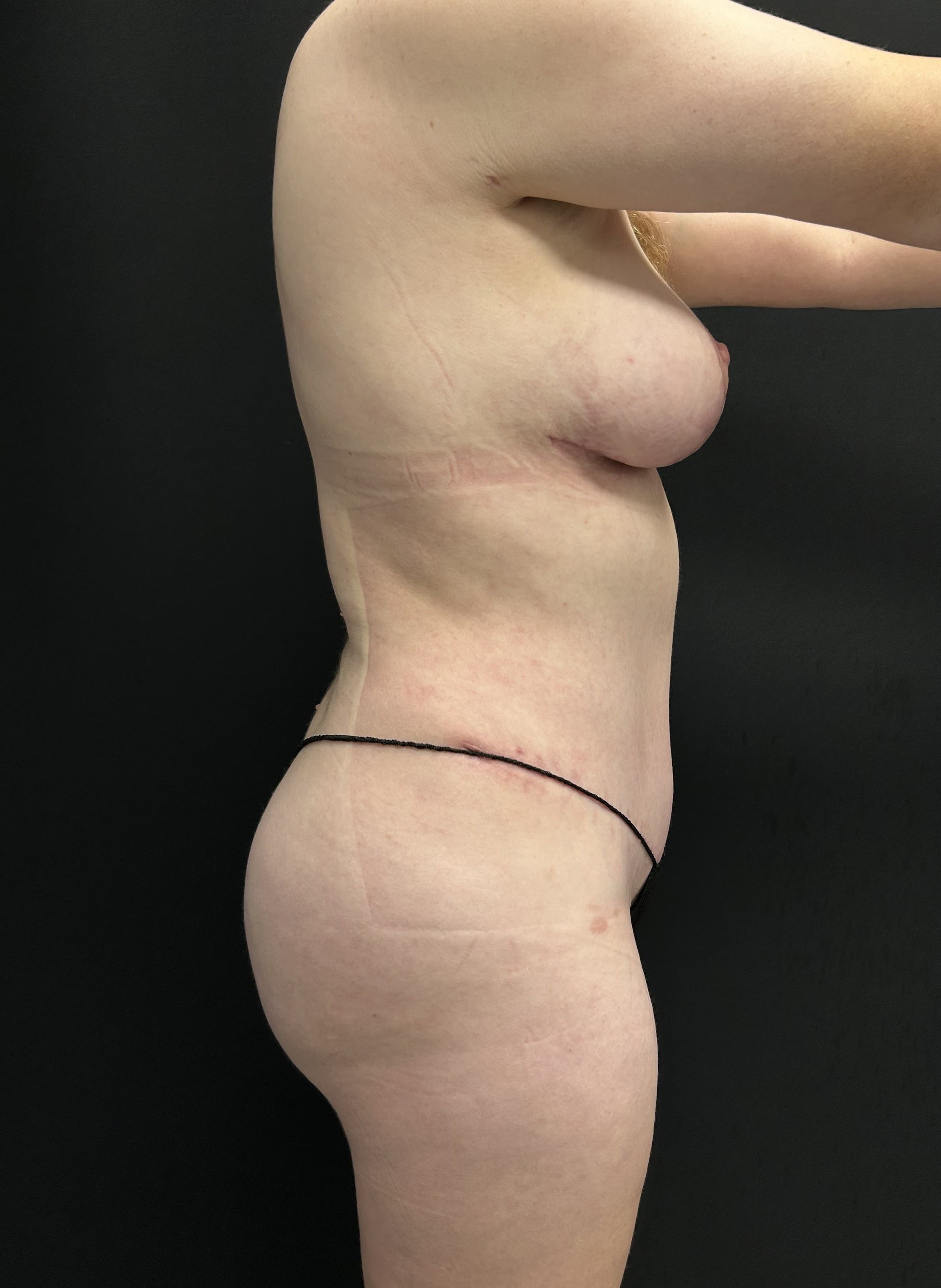 Mommy Makeover After - Patient 5289 - Right View
