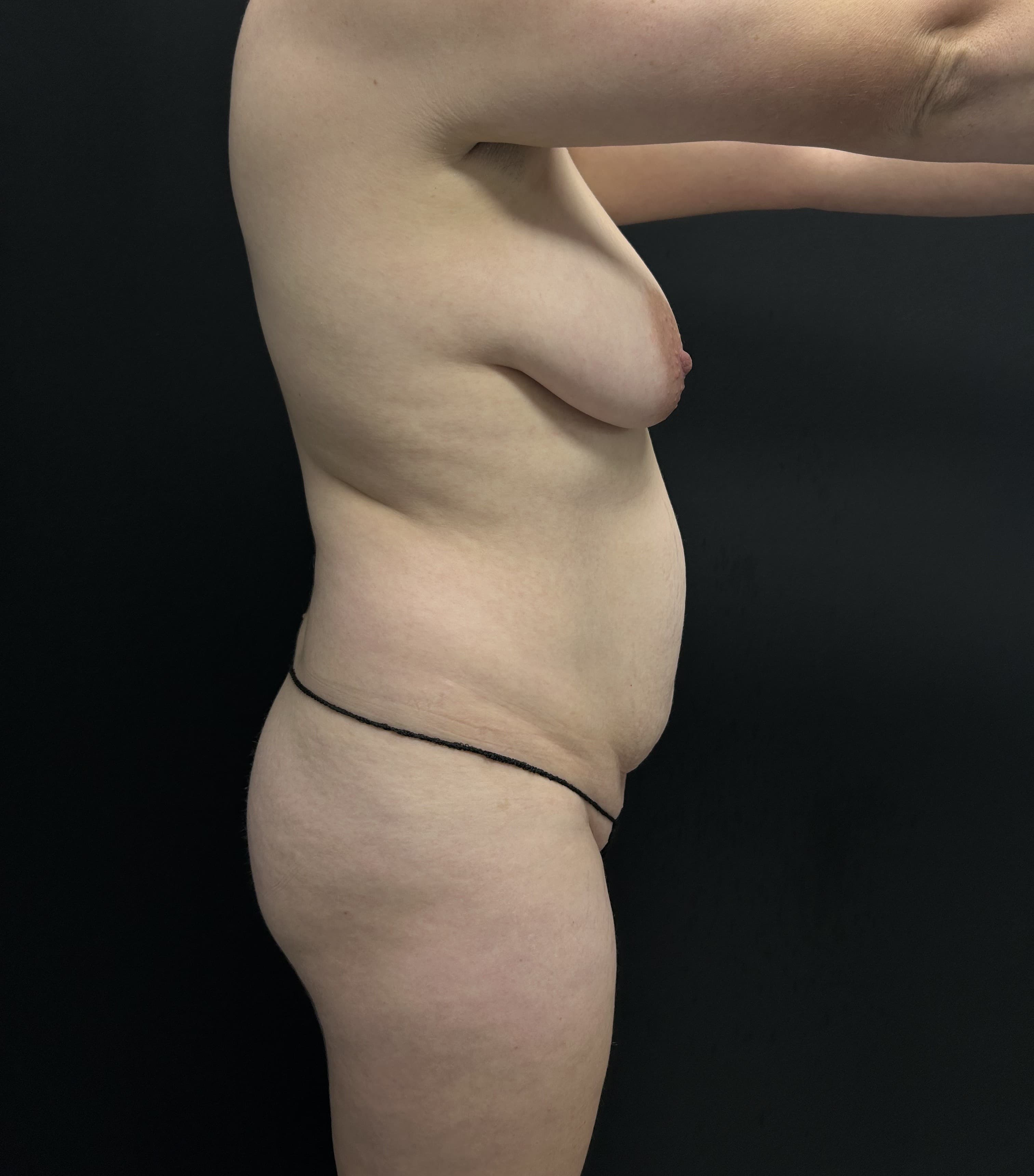 Mommy Makeover Before - Patient 5289 - Right View