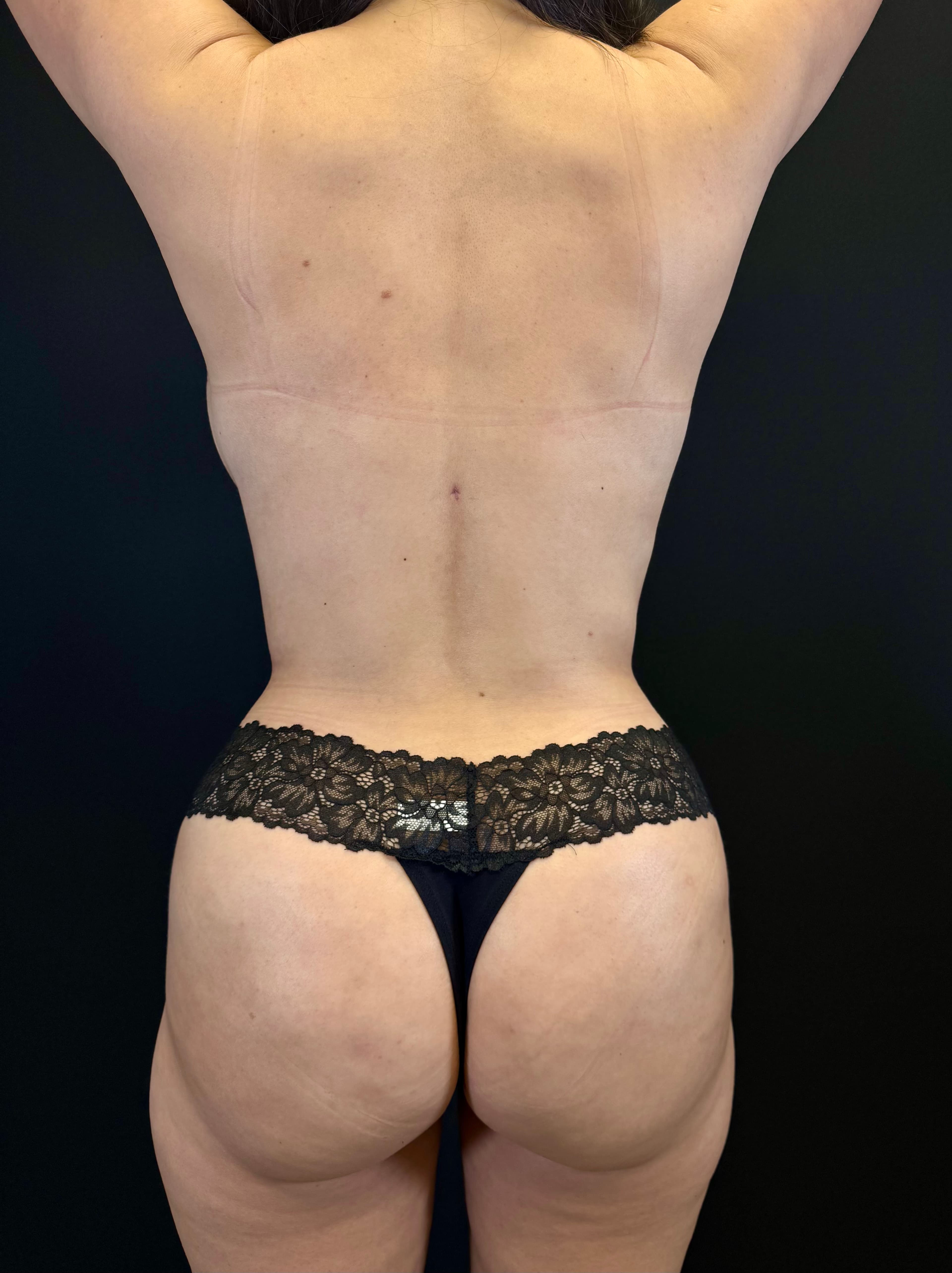 Mommy Makeover After - Patient 5692 - Back View