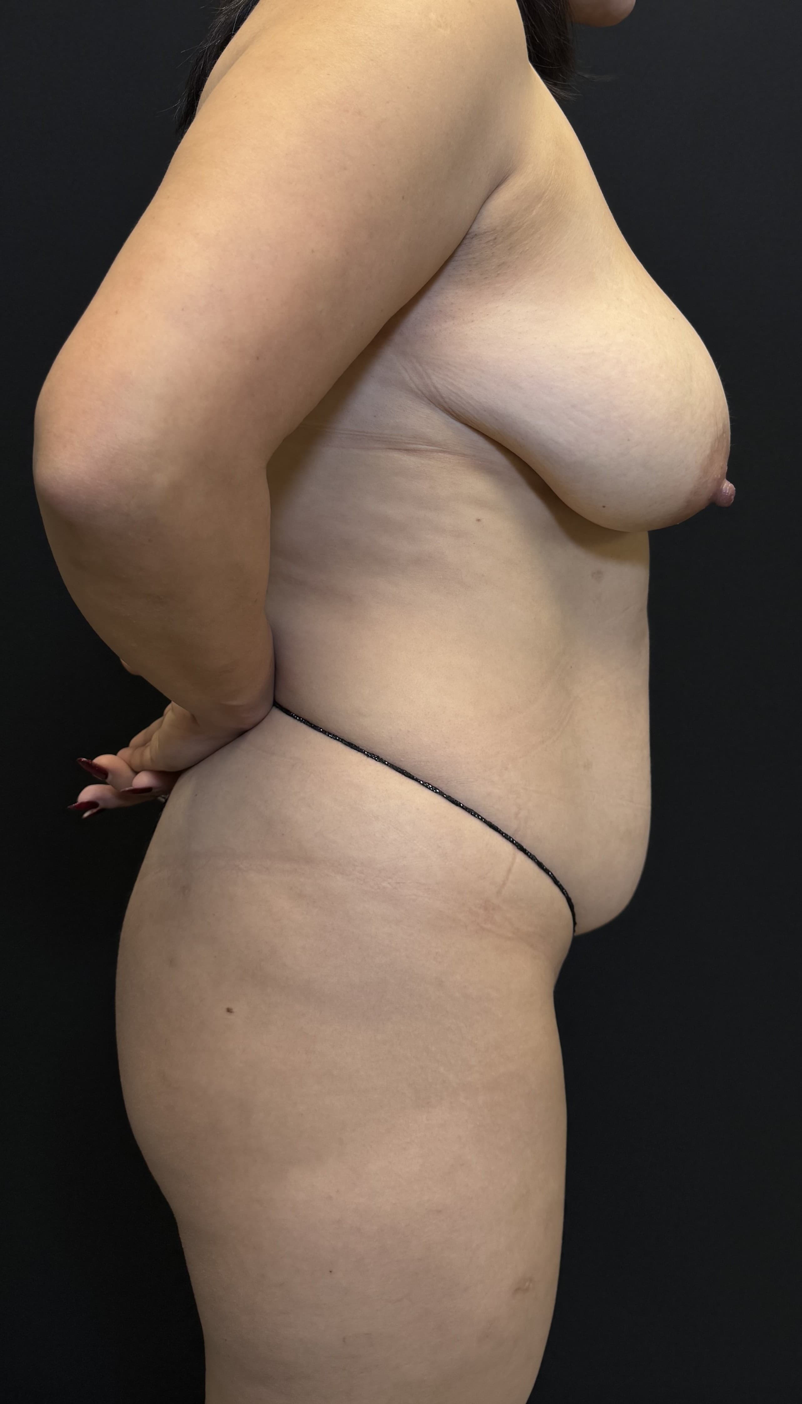 Mommy Makeover Before - Patient 5692 - Right View