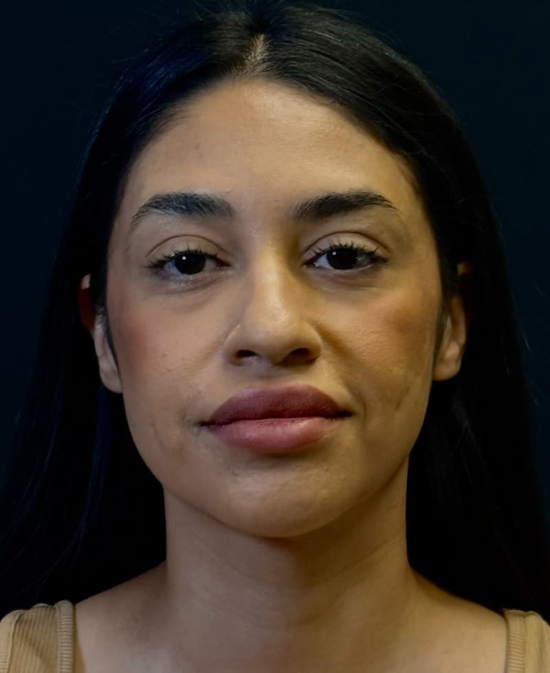 Renuvion J-Plasma After - Patient 102069 - Front View