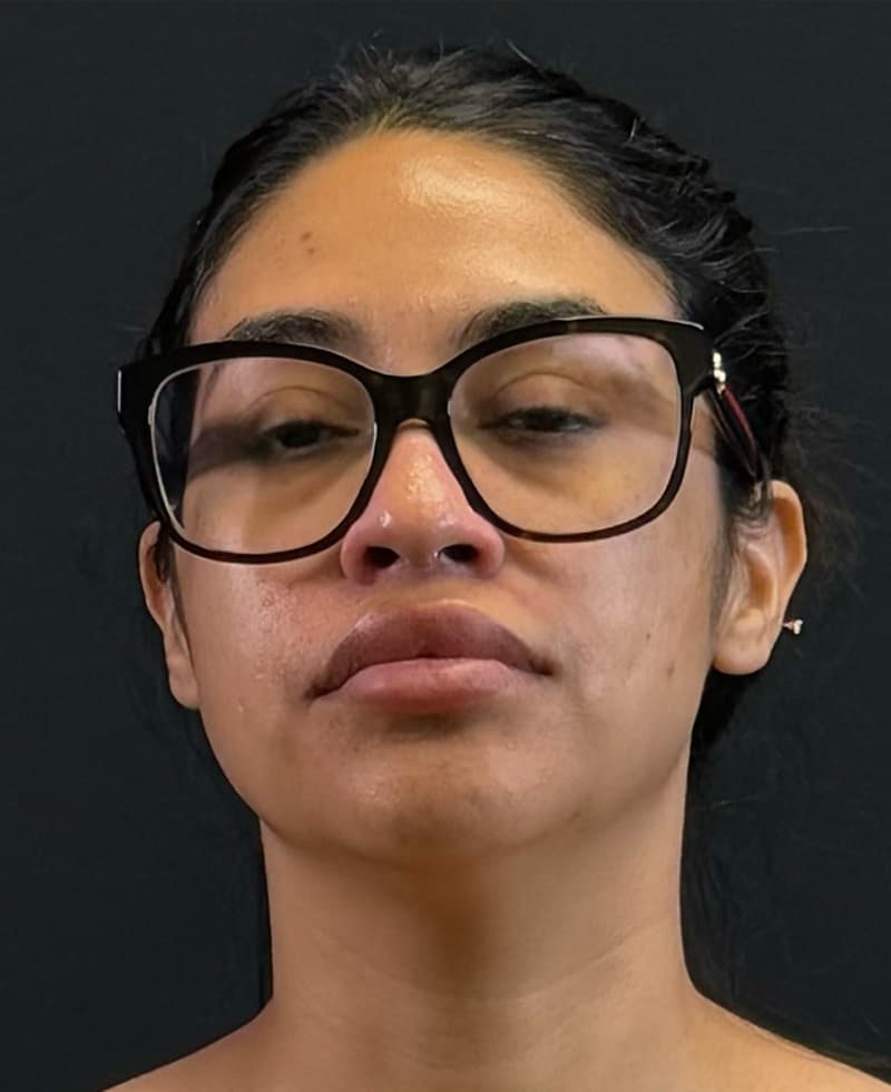 Renuvion J-Plasma Before - Patient 102069 - Front View