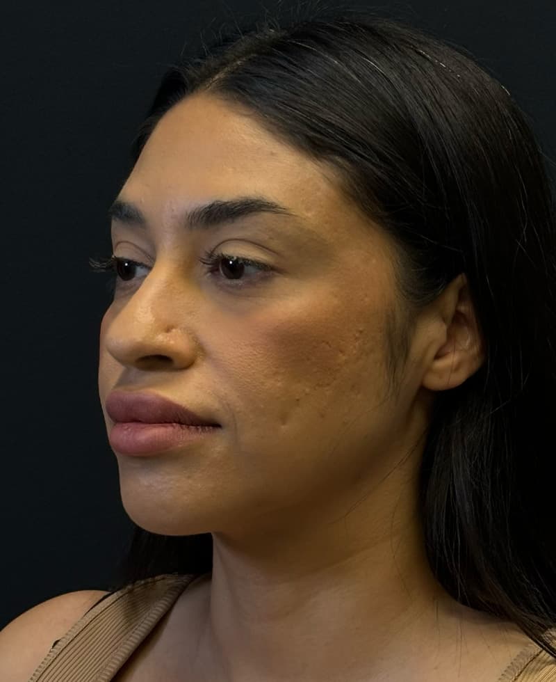 Renuvion J-Plasma After - Patient 102069 - Front Left View