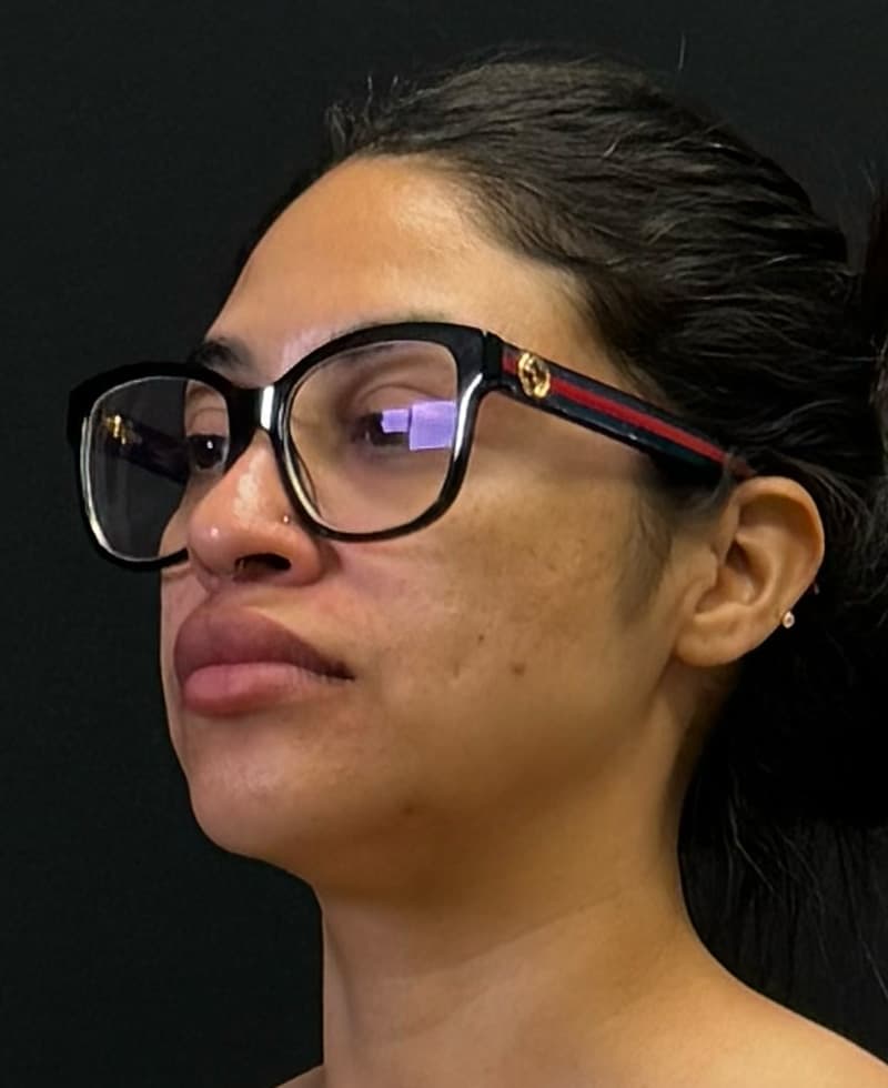 Renuvion J-Plasma Before - Patient 102069 - Front Left View