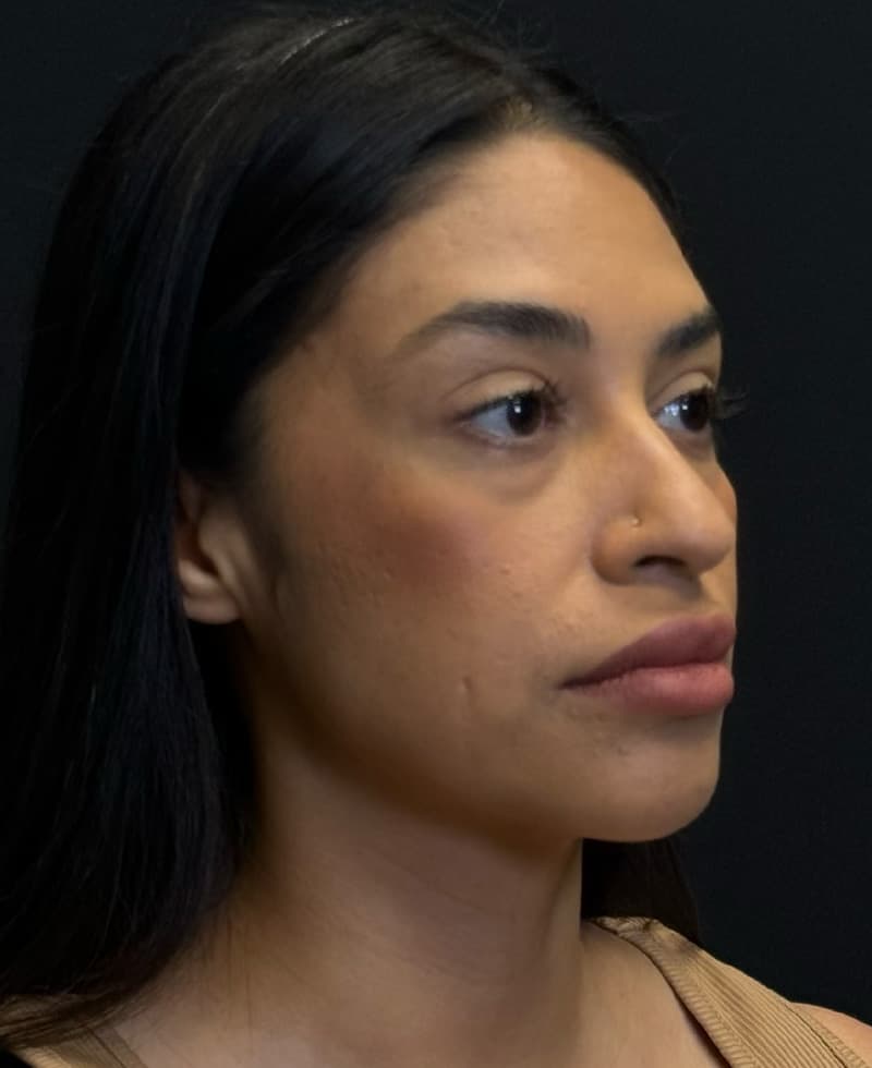 Renuvion J-Plasma After - Patient 102069 - Front Right View