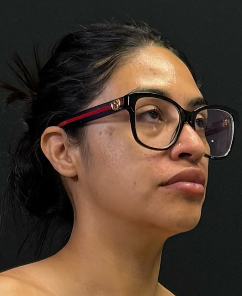 Renuvion J-Plasma Before - Patient 102069 - Front Right View