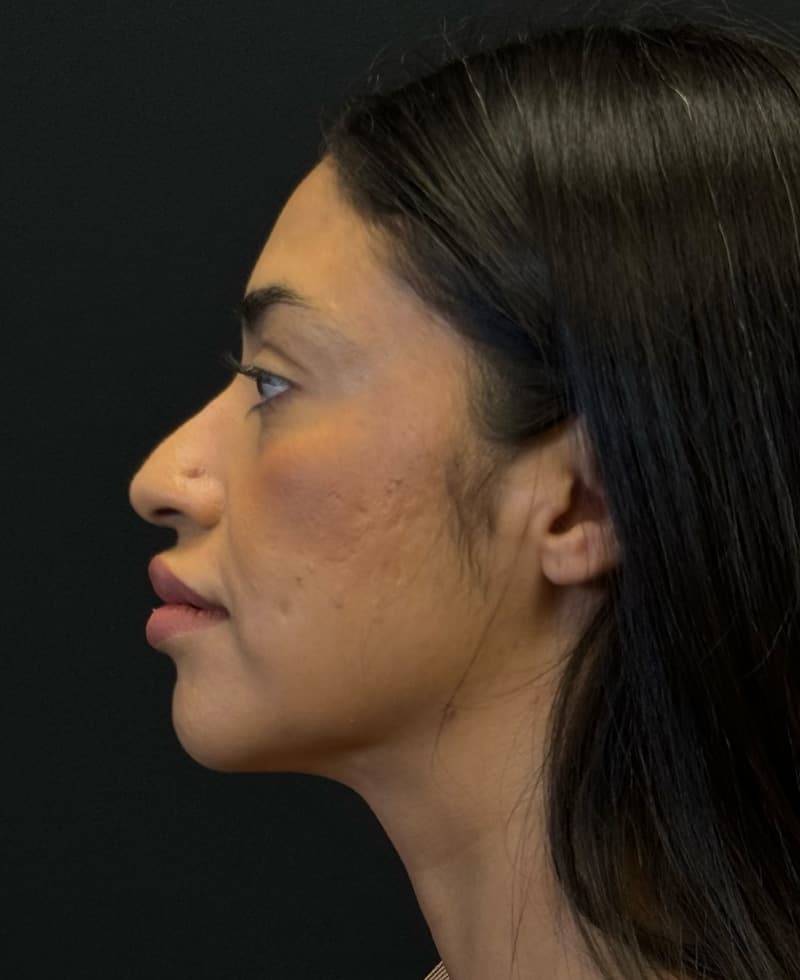 Renuvion J-Plasma After - Patient 102069 - Left View