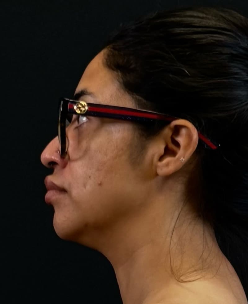 Renuvion J-Plasma Before - Patient 102069 - Left View