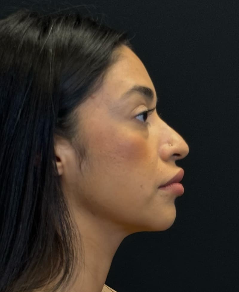 Renuvion J-Plasma After - Patient 102069 - Right View