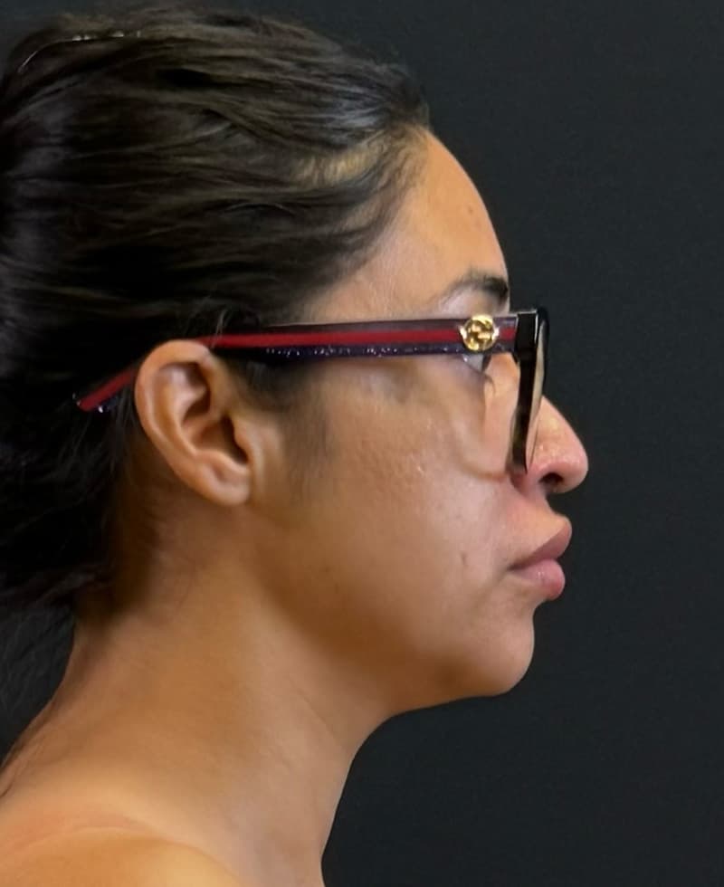 Renuvion J-Plasma Before - Patient 102069 - Right View