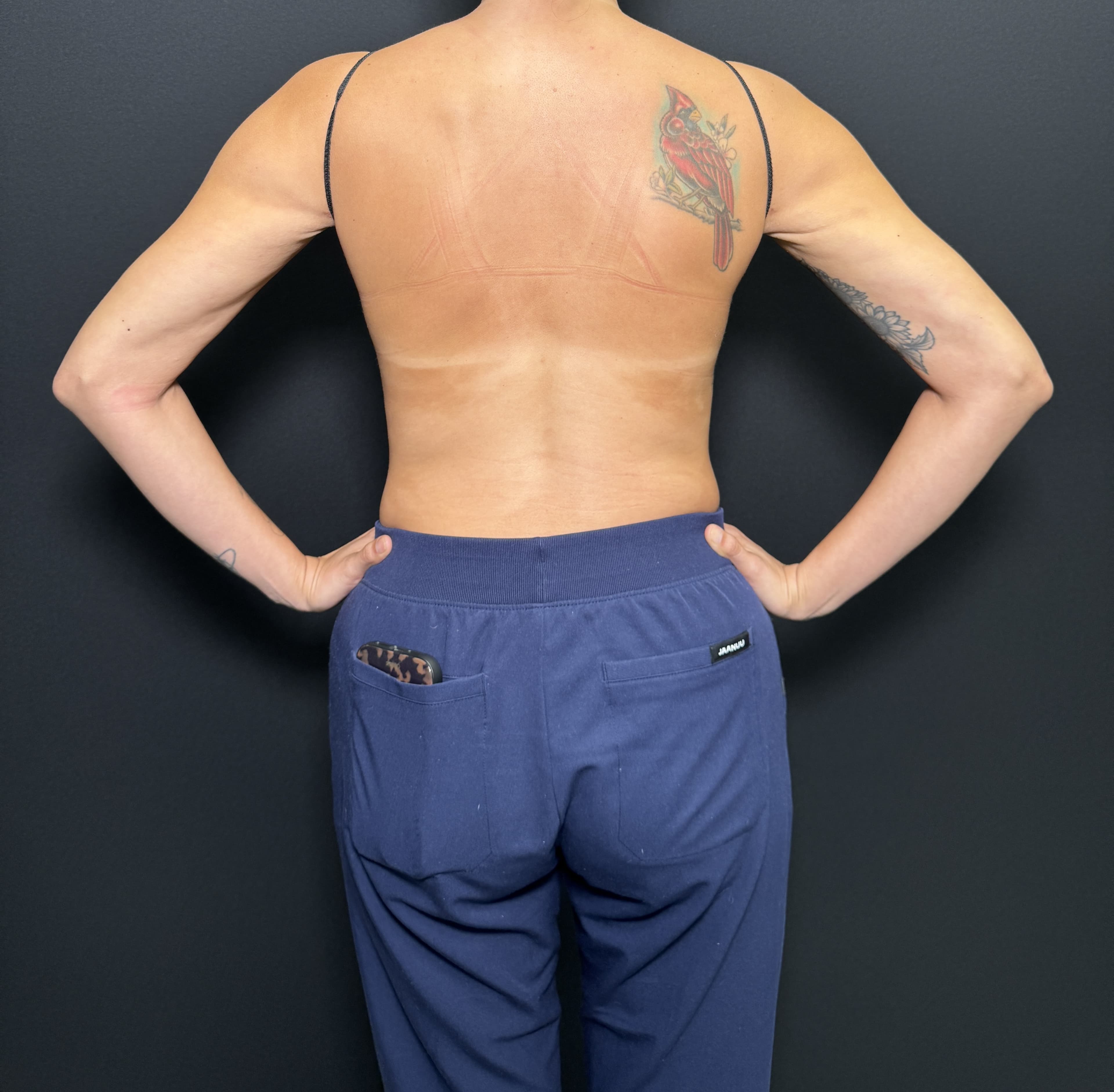 Renuvion J-Plasma After - Patient 2247 - Back View