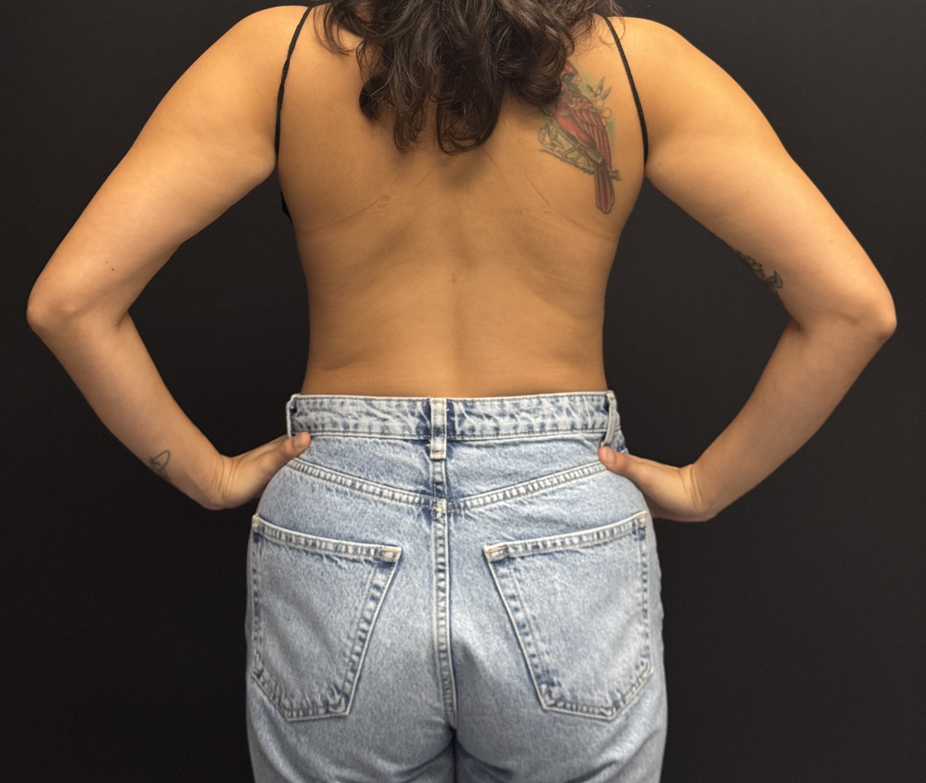 Renuvion J-Plasma Before - Patient 2247 - Back View