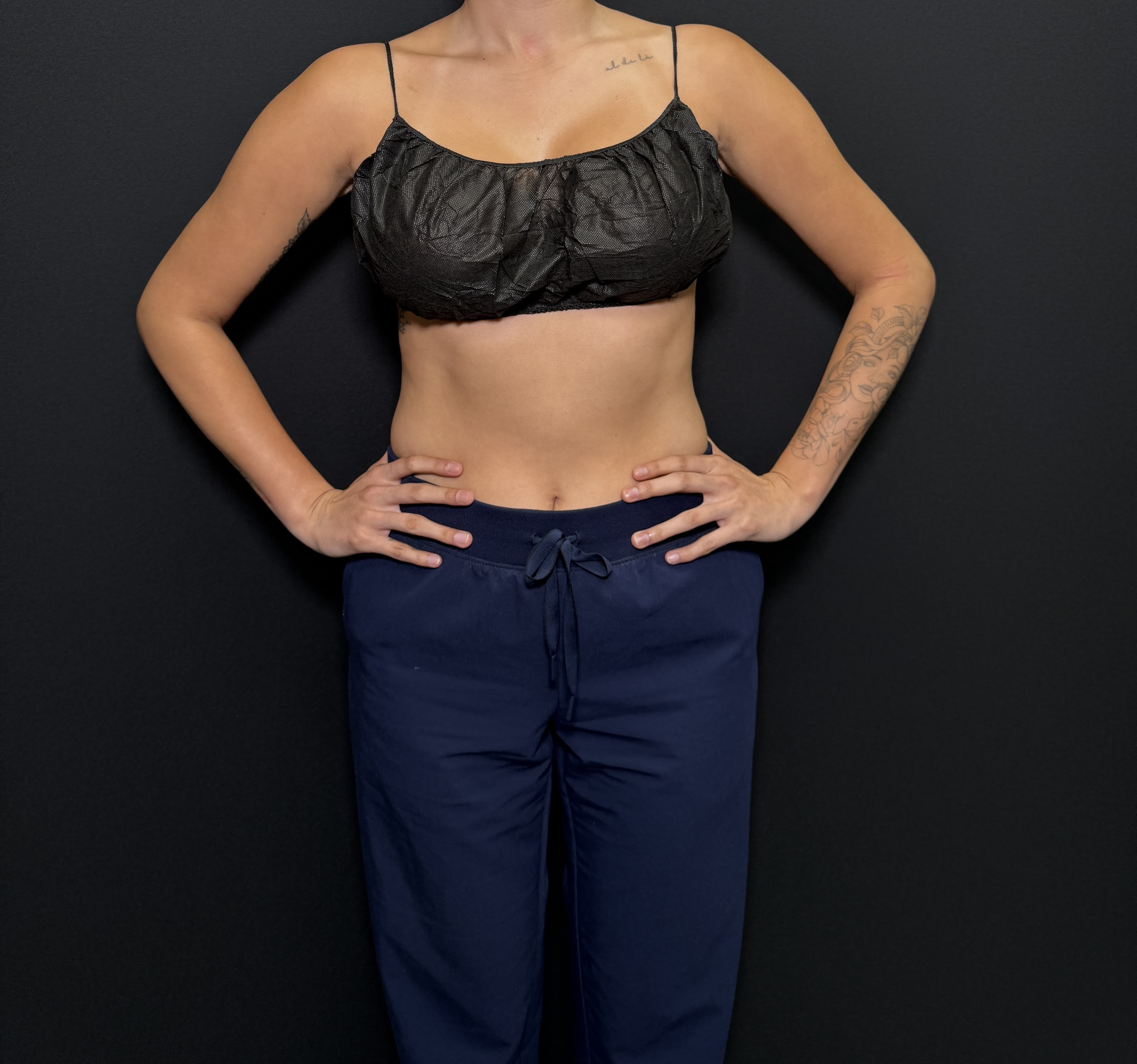 Renuvion J-Plasma After - Patient 2247 - Front View