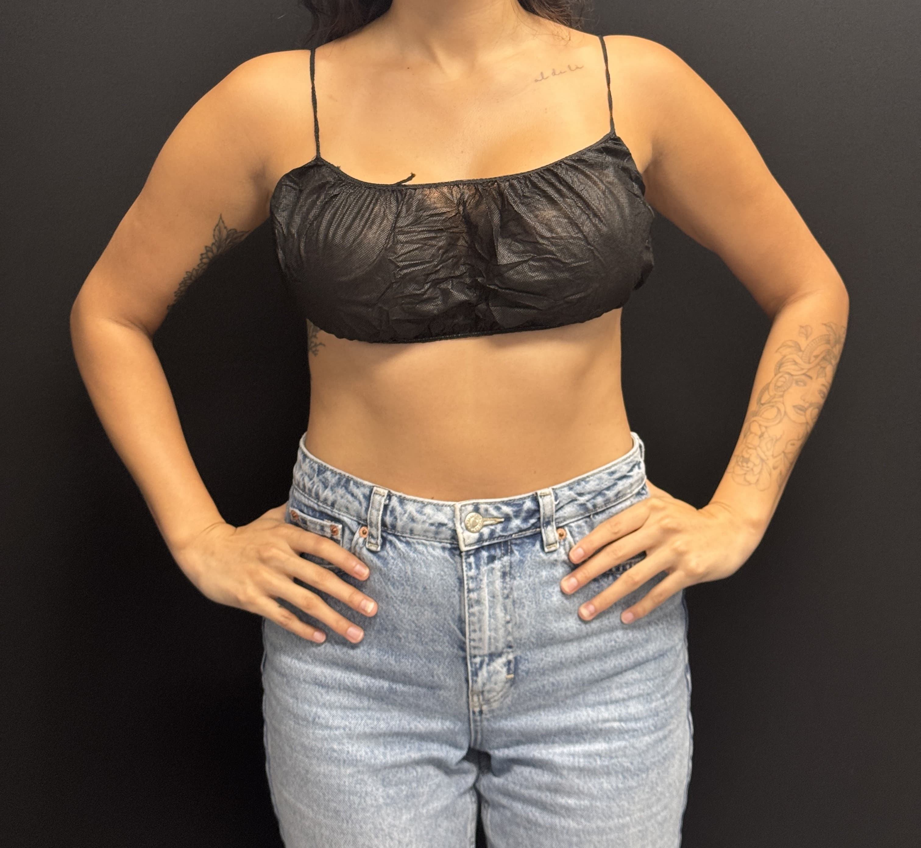 Renuvion J-Plasma Before - Patient 2247 - Front View