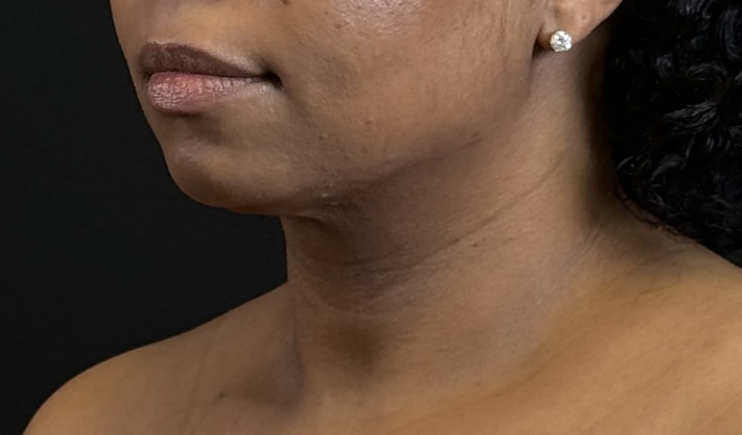 Renuvion J-Plasma After - Patient 3989 - Front Left View